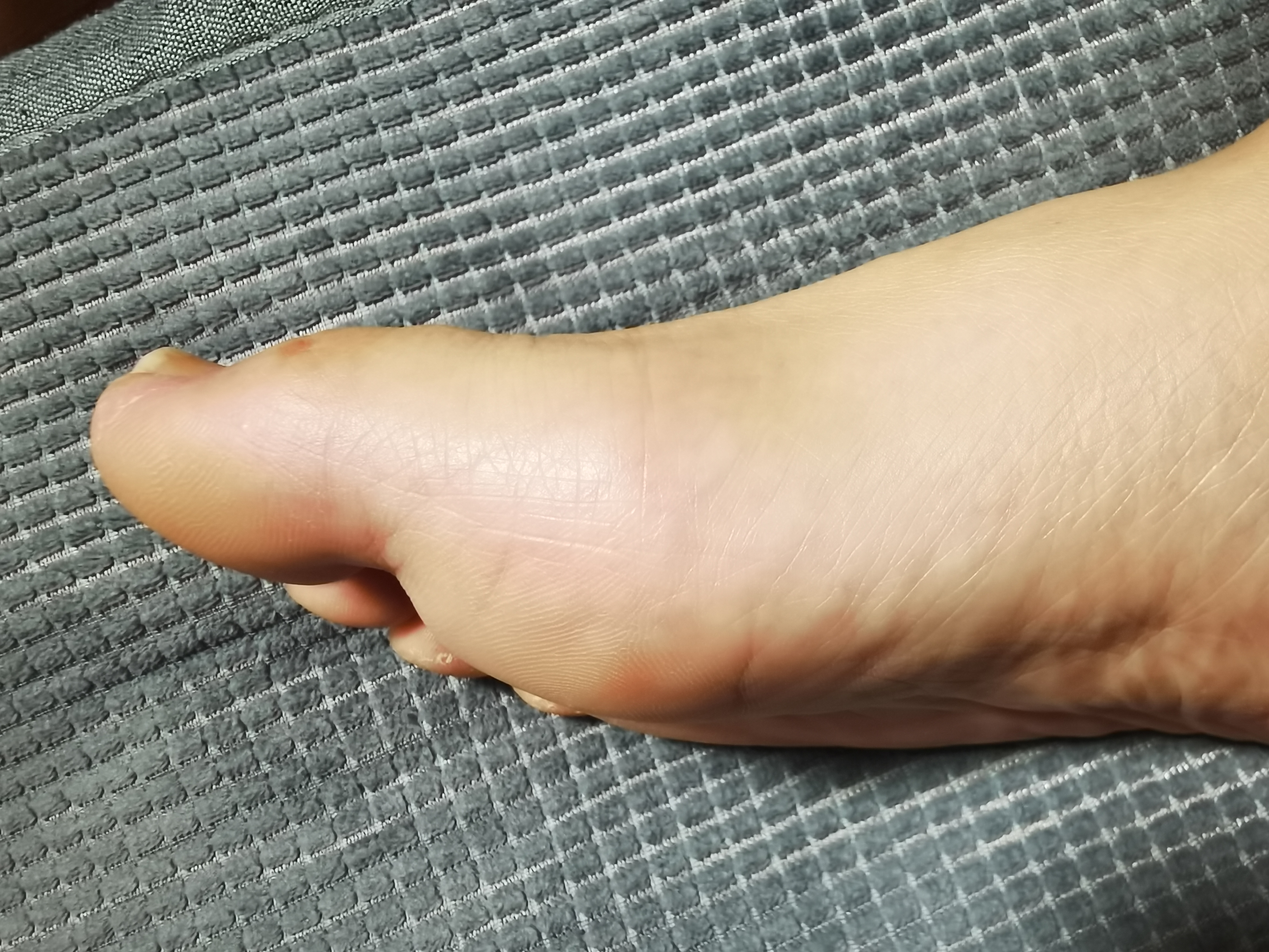 为什么打完飞机就犯痛风