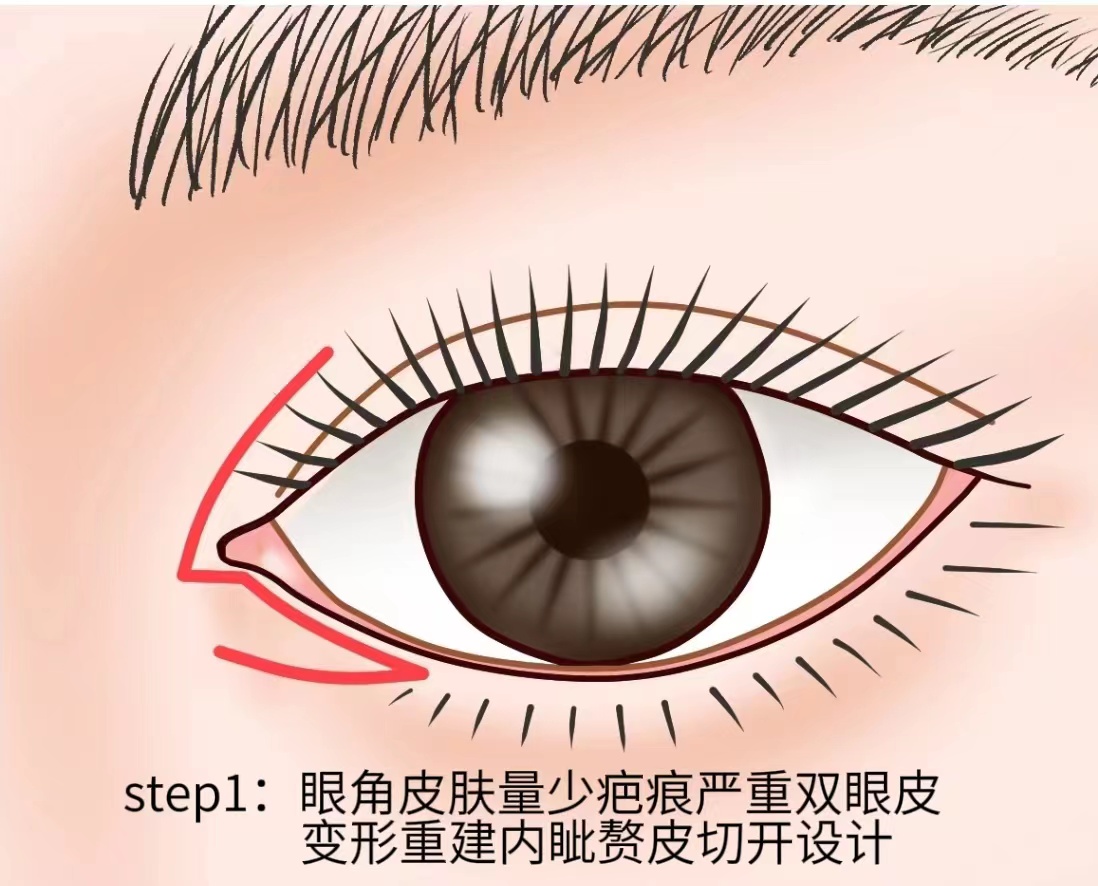 鳍形皮瓣法# 适用于眼角部分皮肤不足,留疤严重需内眦眦皮重建的人