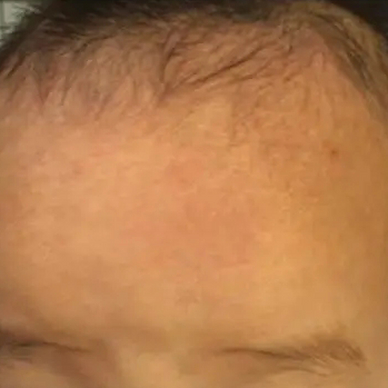 家人意外发现孩子额头上出现了红斑,短短一个月,颜色越来越鲜红,还有