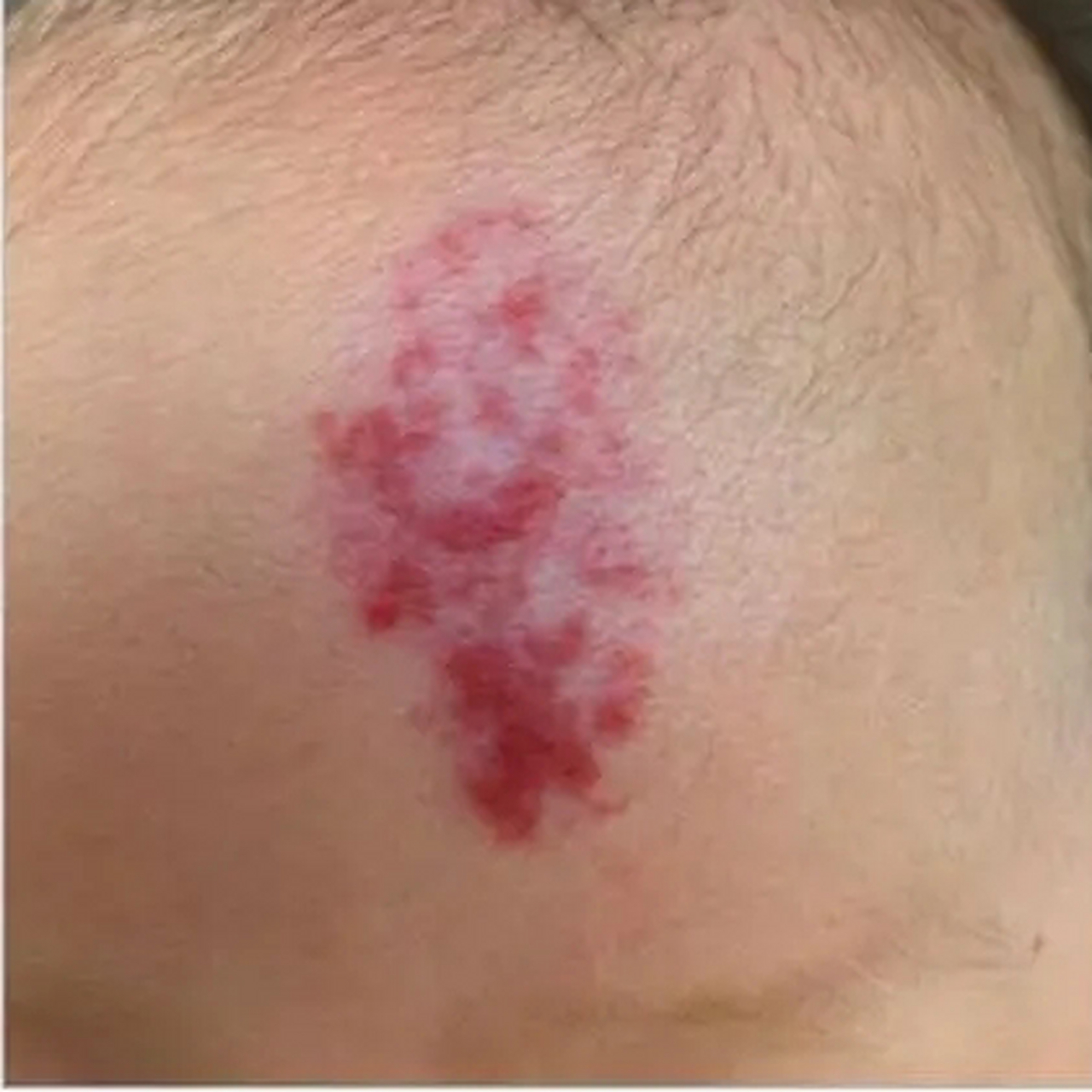 家人意外发现孩子额头上出现了红斑,短短一个月,颜色越来越鲜红,还有