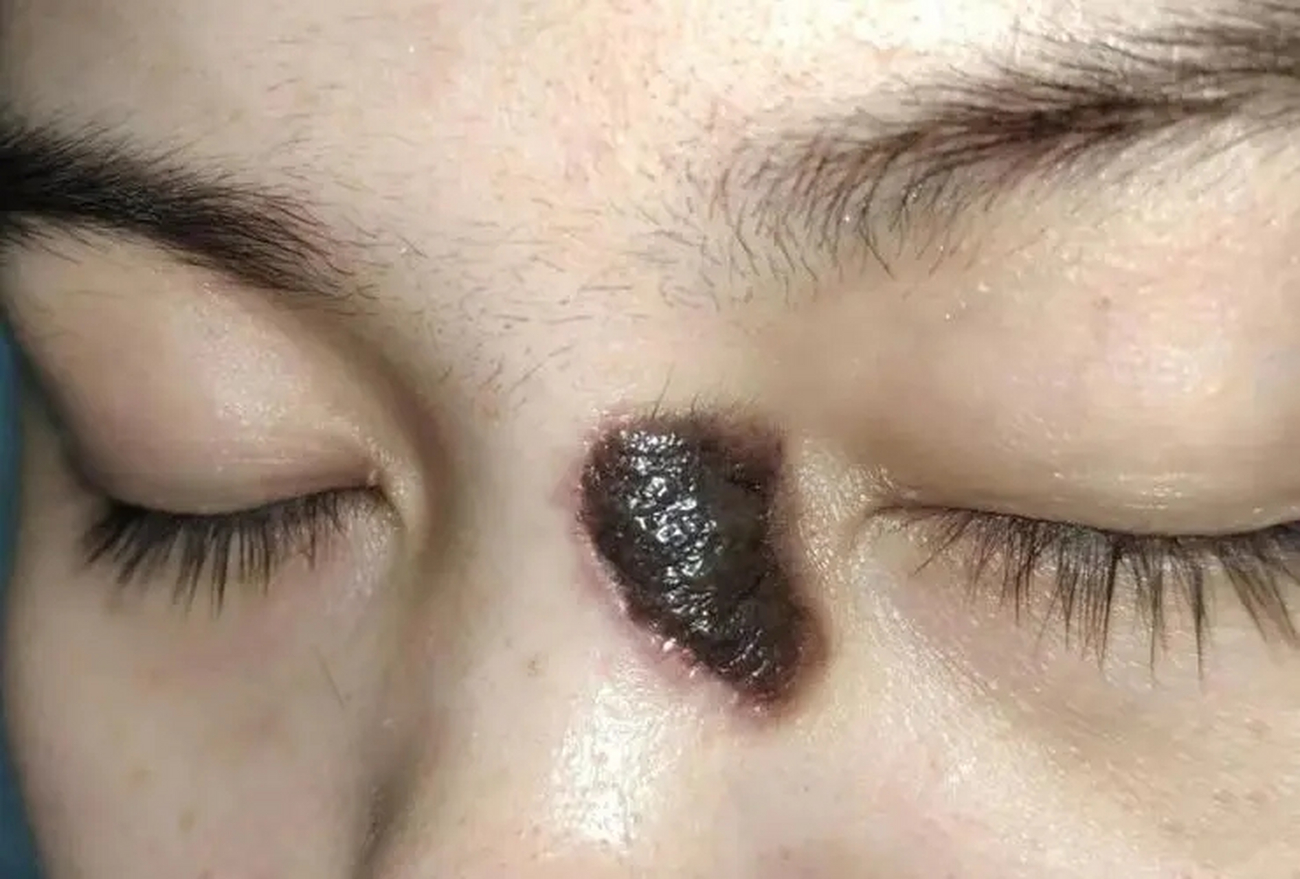 青少年是祖国的花朵,更是家庭的新希望,然而胎记血管瘤却增添了一抹