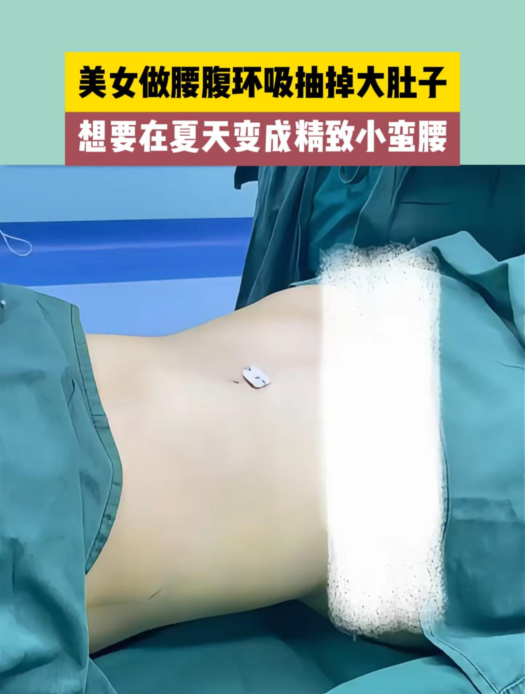 美女做腰腹环吸抽掉大肚子,想要夏天变成精致小蛮腰