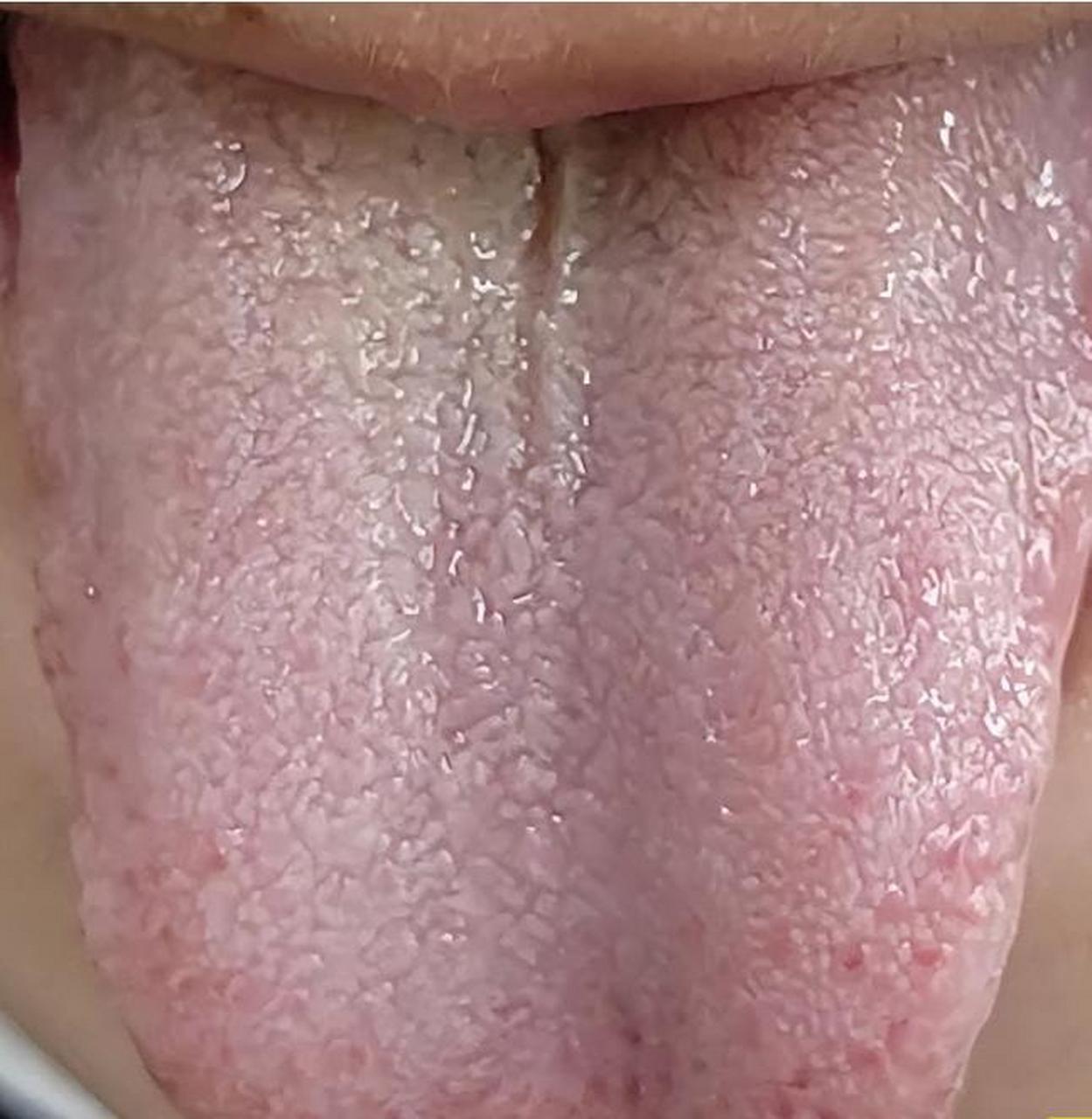 中医小柴胡汤,会用了,解肝郁很快!