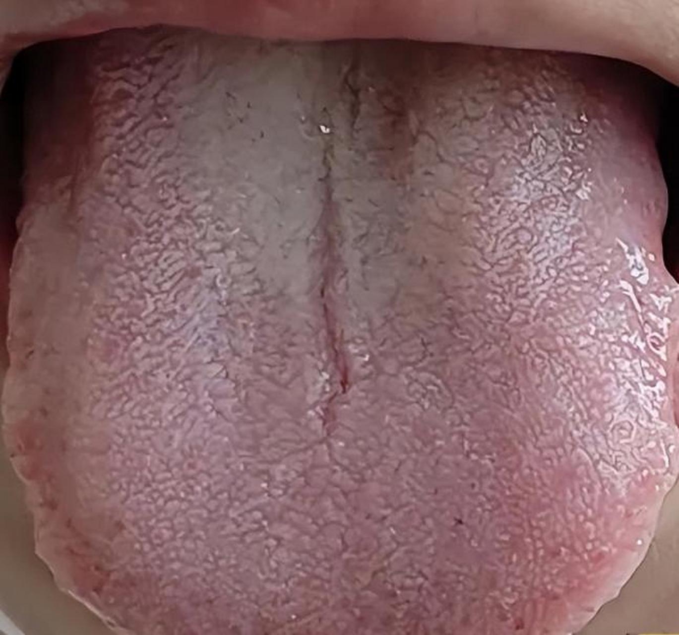 中医小柴胡汤,会用了,解肝郁很快!