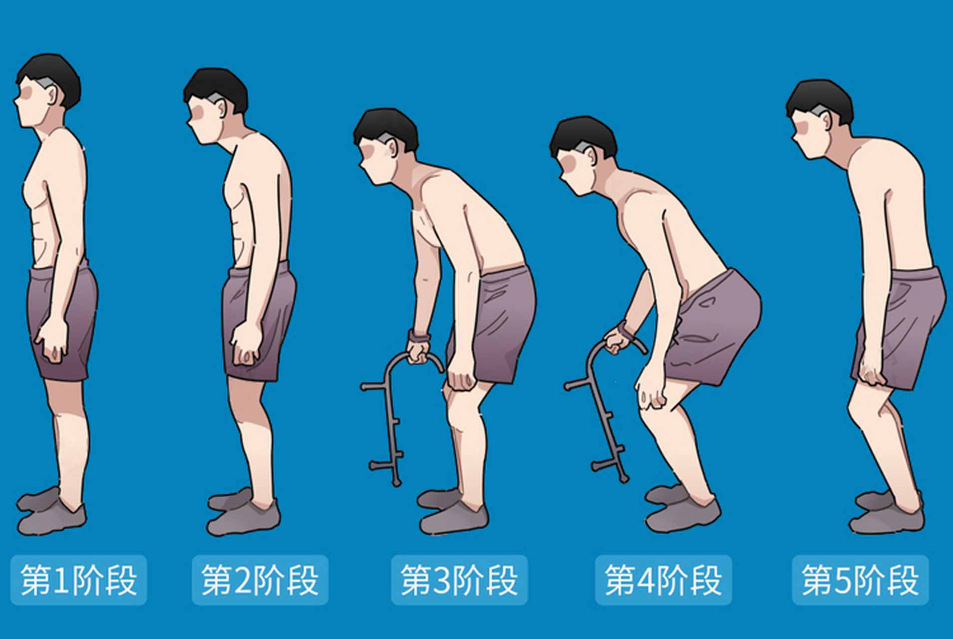 强直性脊柱炎位置图片