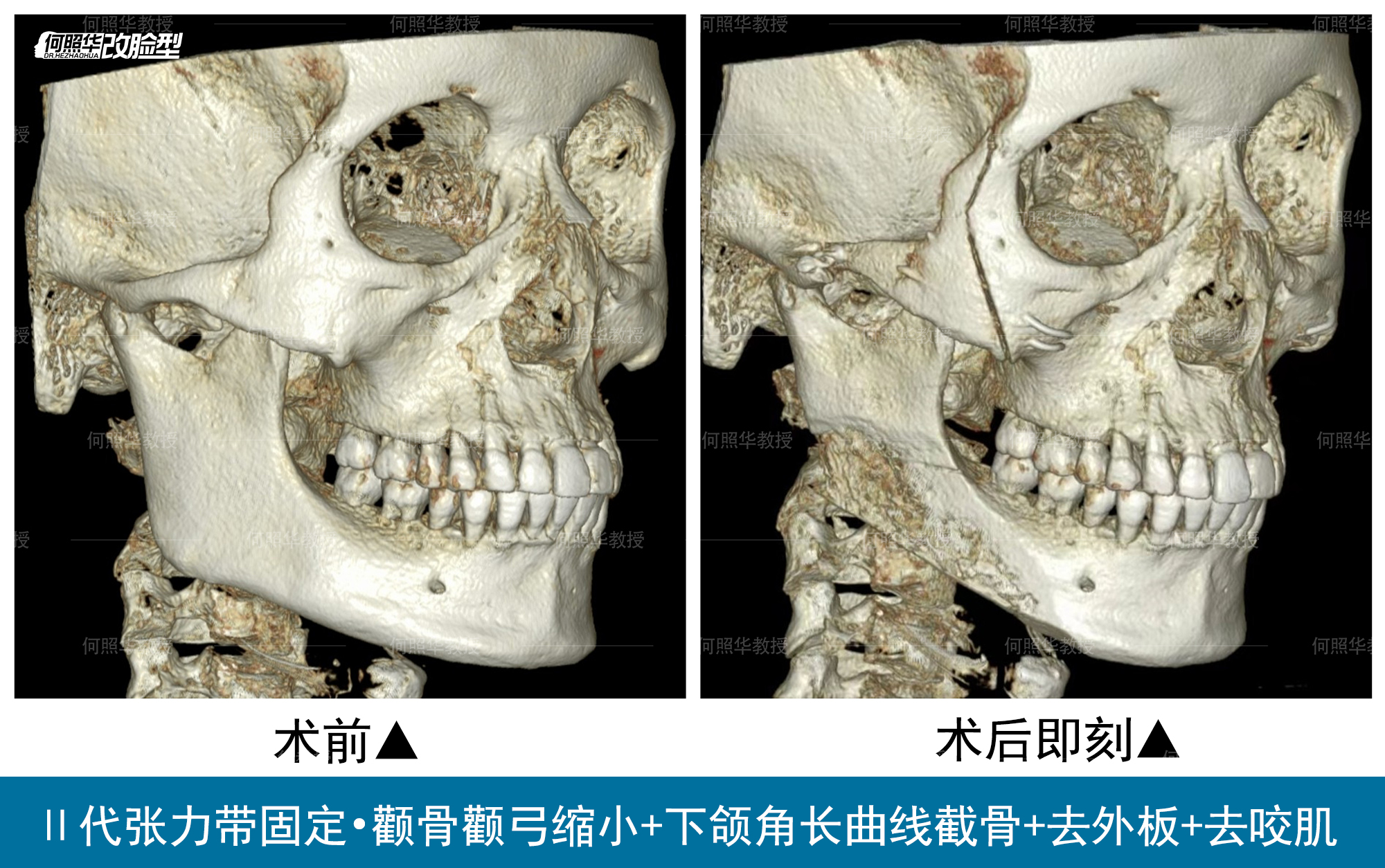 昨天和大家分享了做颧骨内推和下颌u型截骨的姑娘的骨片,今天和大家