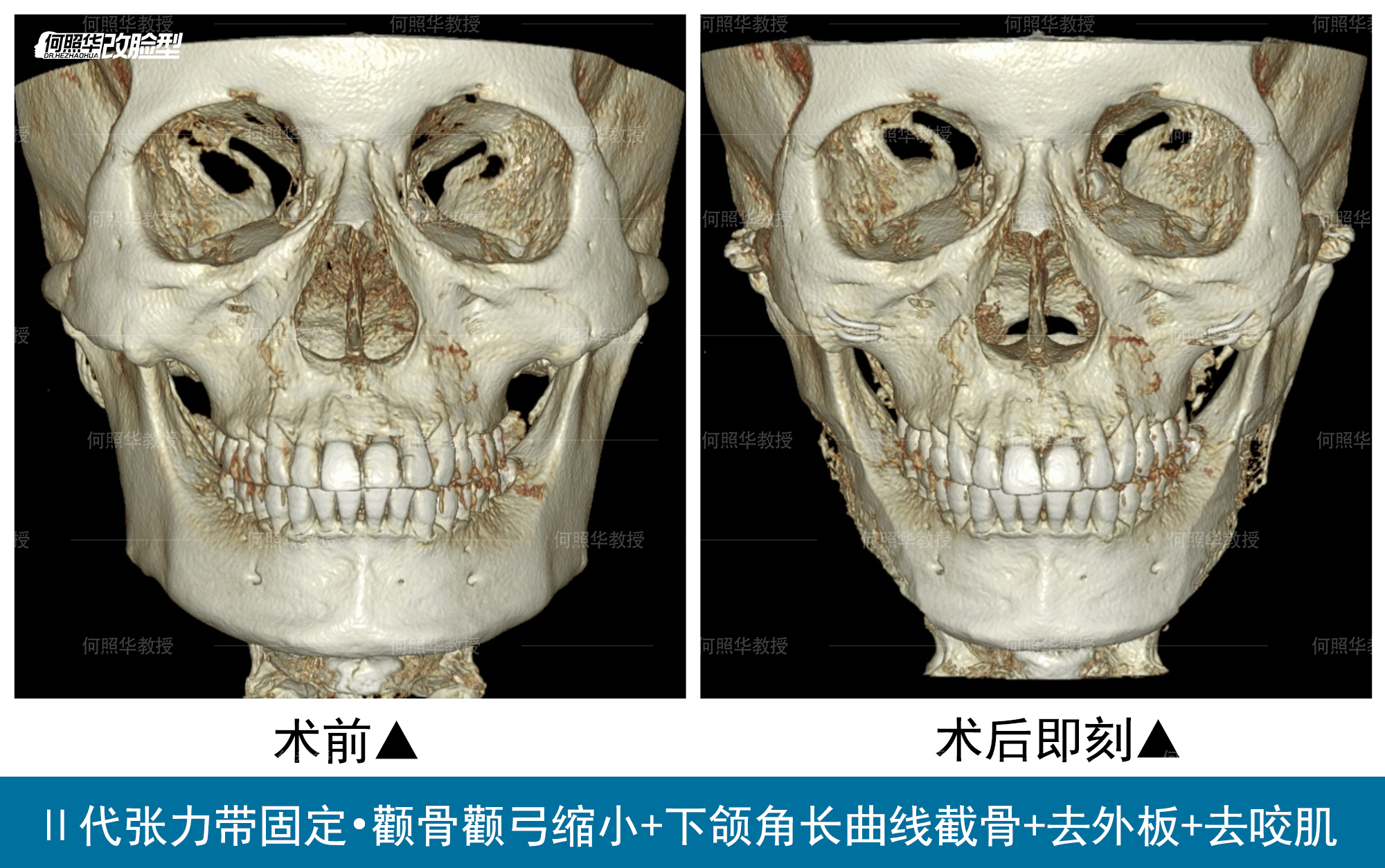 昨天和大家分享了做颧骨内推和下颌u型截骨的姑娘的骨片,今天和大家
