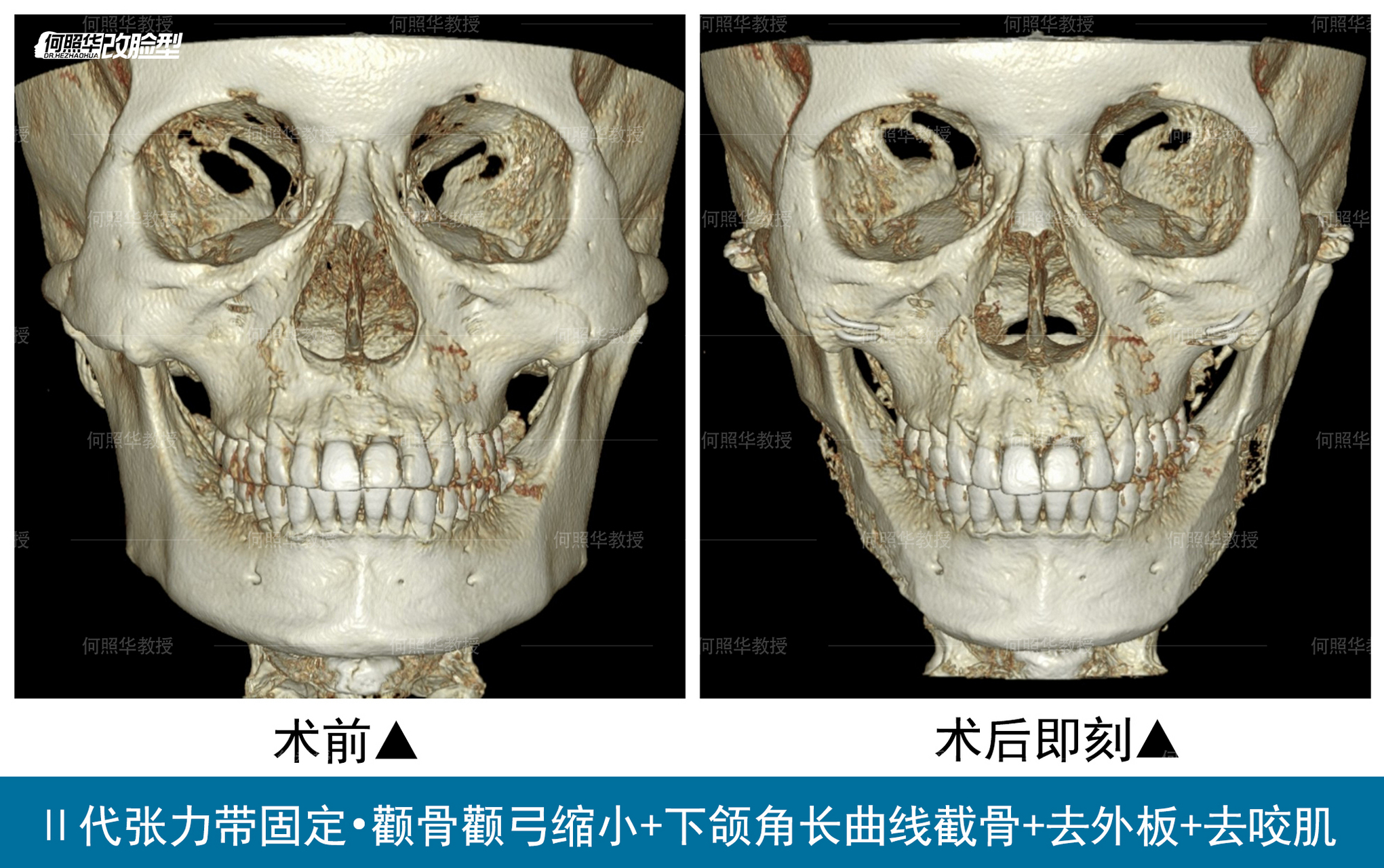 颧骨内推ct图片