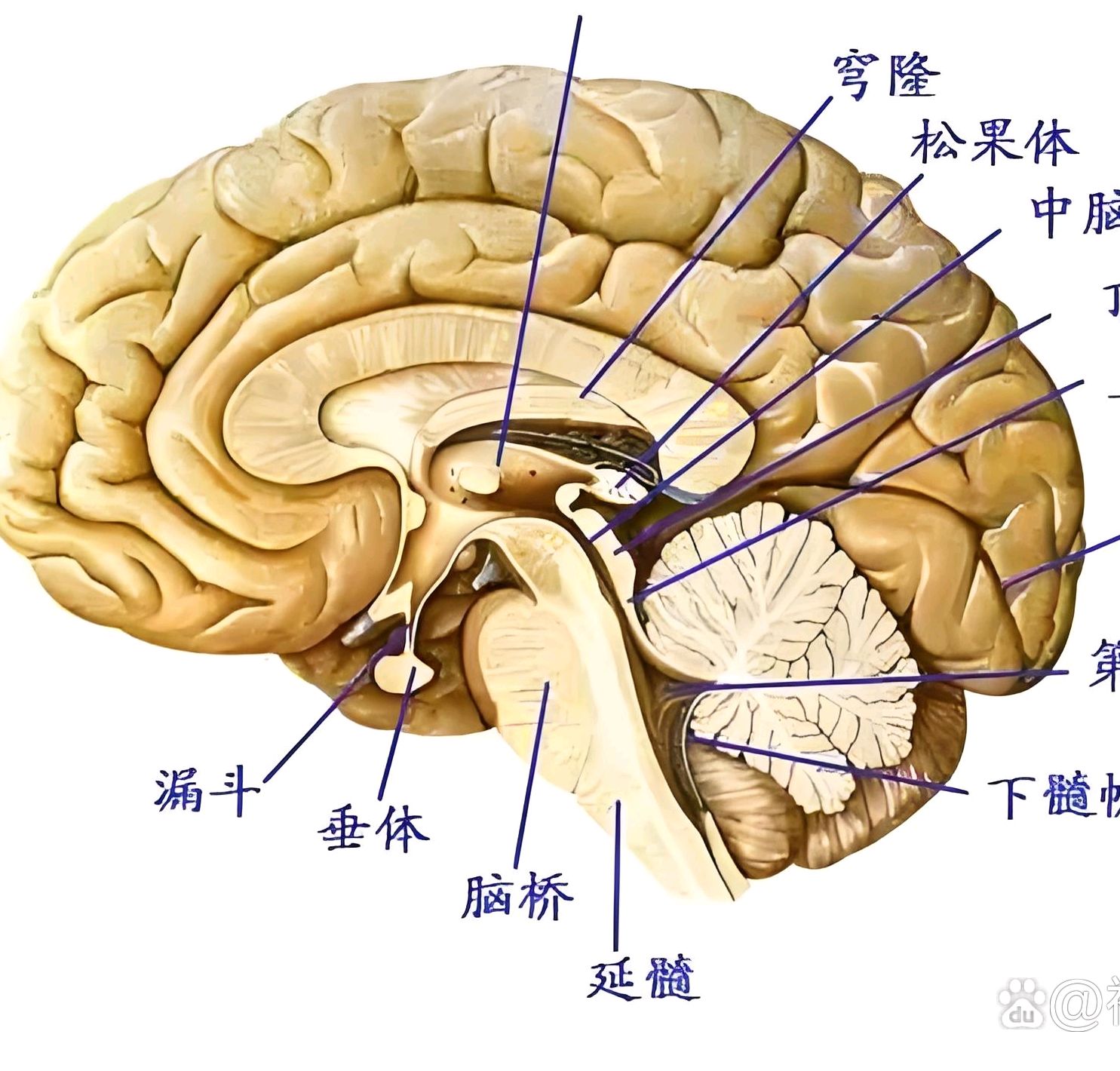 小脑蚓部出血图片