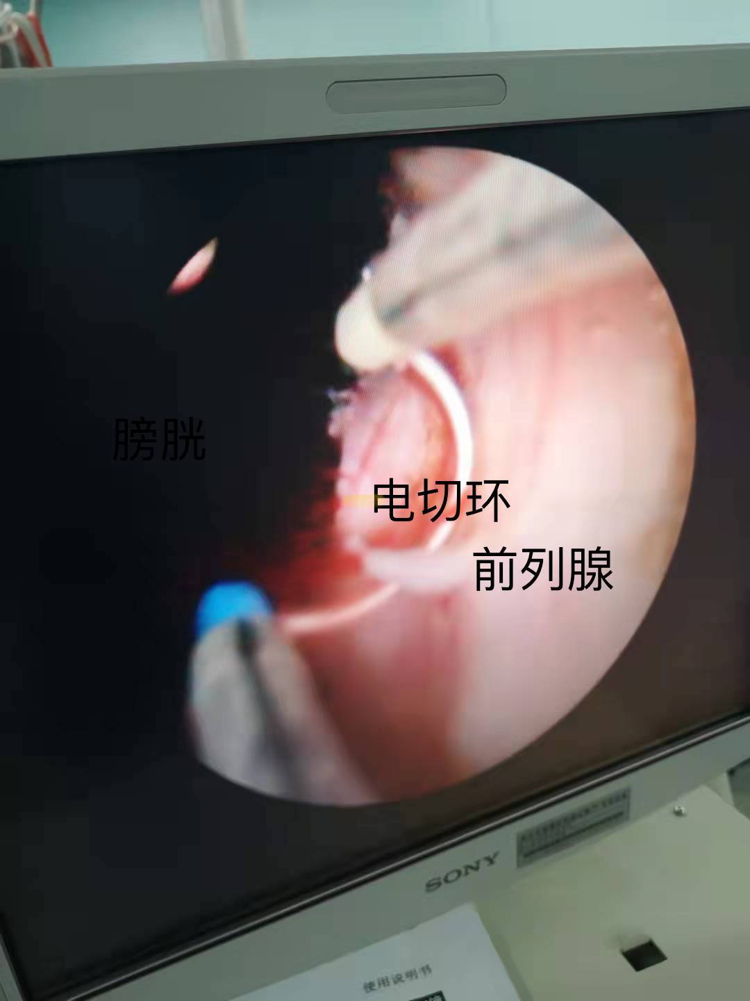 前列腺增生手术做完就可以高枕无忧了吗?