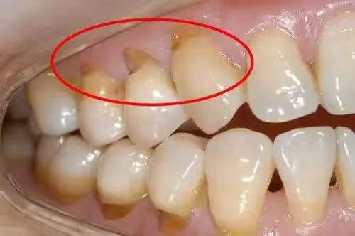 为什么牙齿根部缺了一块?