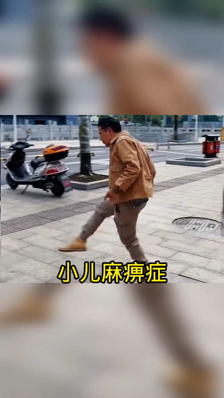 小儿麻痹症,治好病也流口水