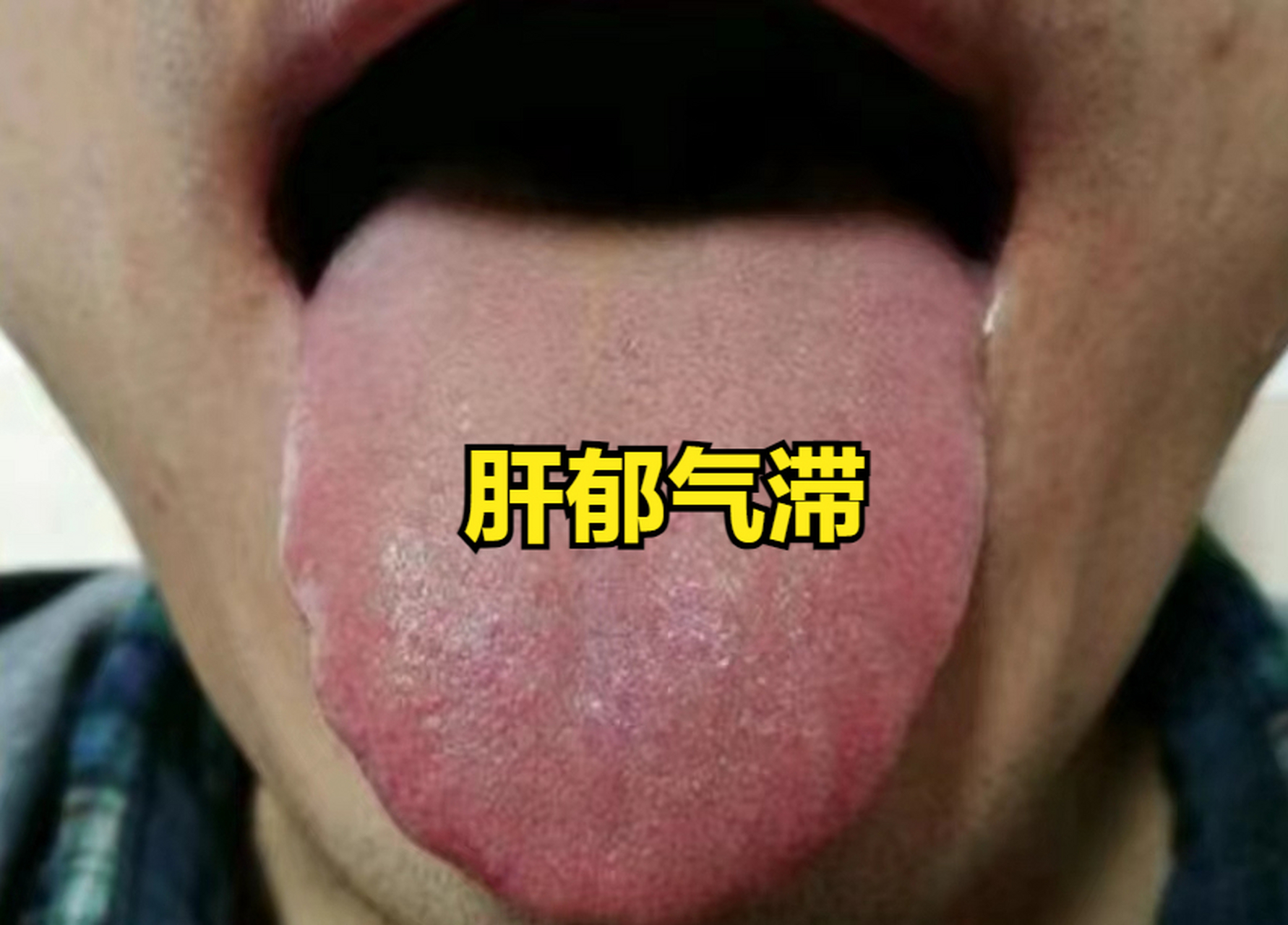 李茂发一病一方治疗便秘(李茂发一病一方120种疑难杂症)