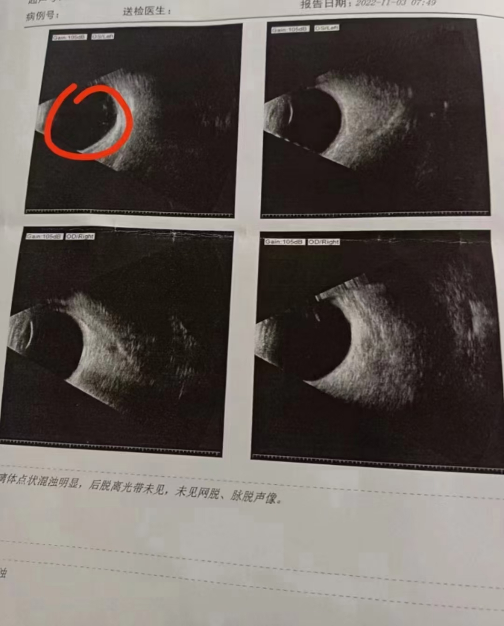 玻璃体后脱离别乱治,先看看这个,专业人士帮你分析,少花冤枉钱让后