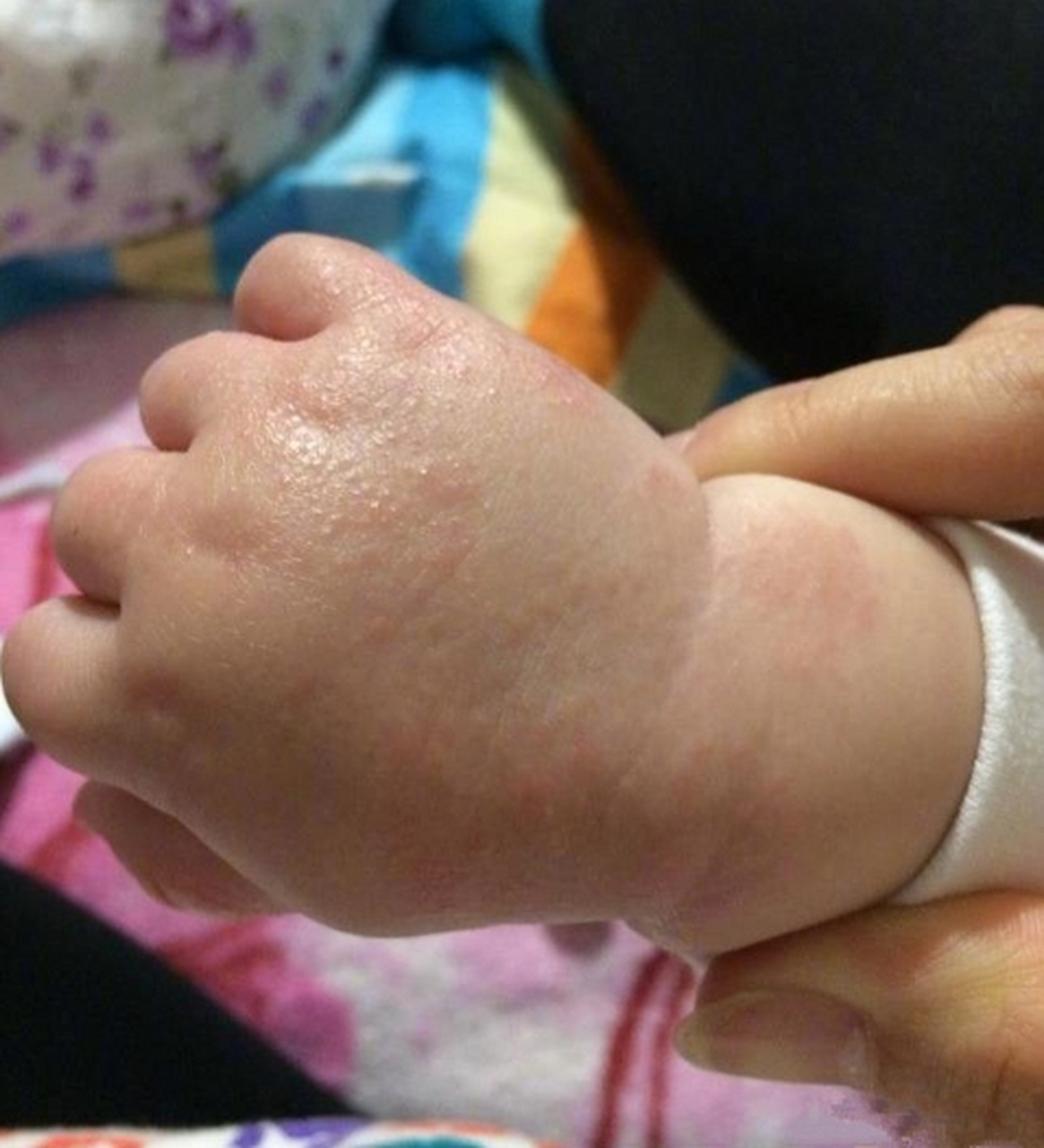 汗疱疹是一种好发于手掌,脚底以及手指和脚趾两侧的水疱性皮肤病,是