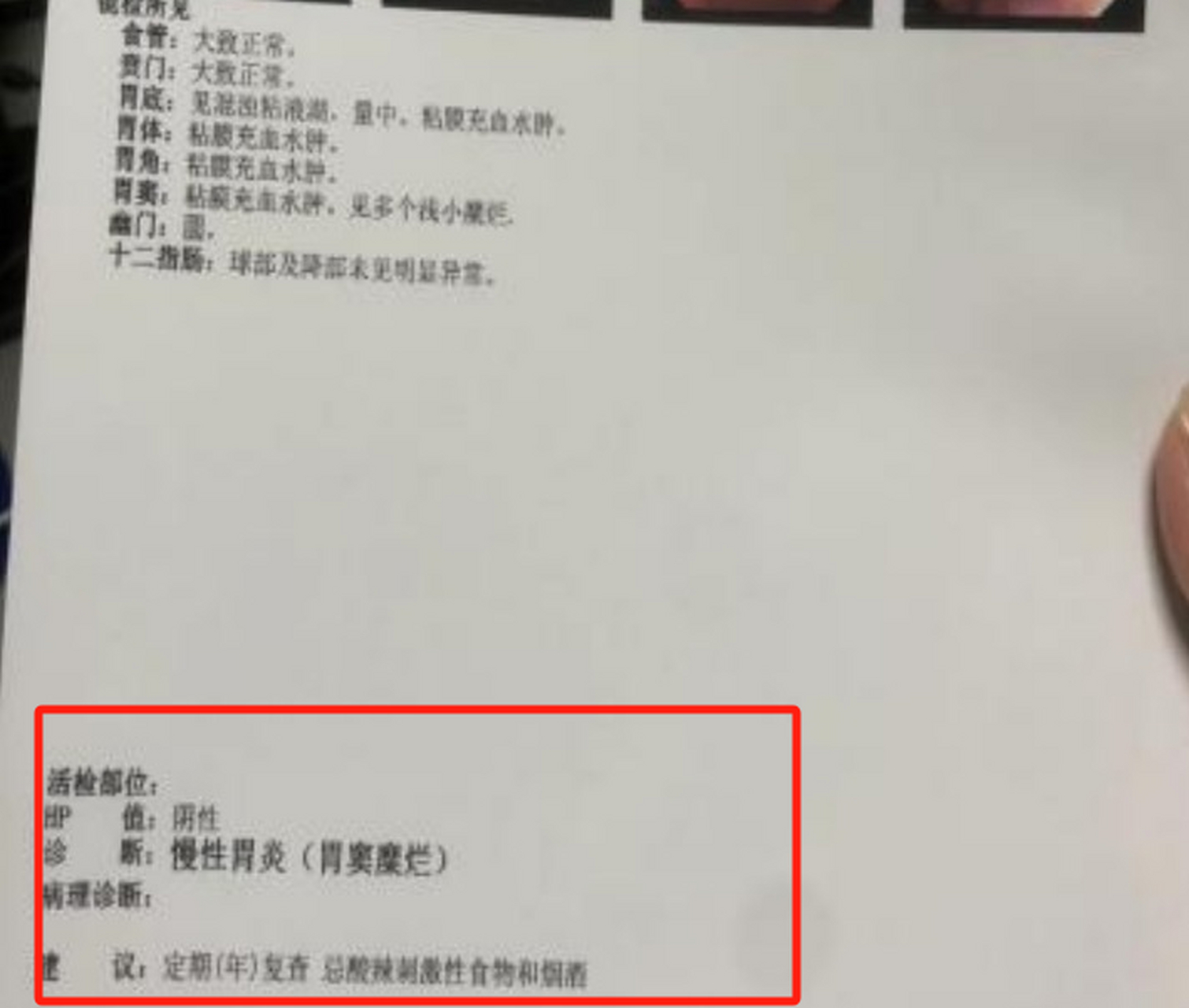 这是一位糜烂性胃炎患者的胃镜检查报告,患者来看诊时,主诉自己反酸