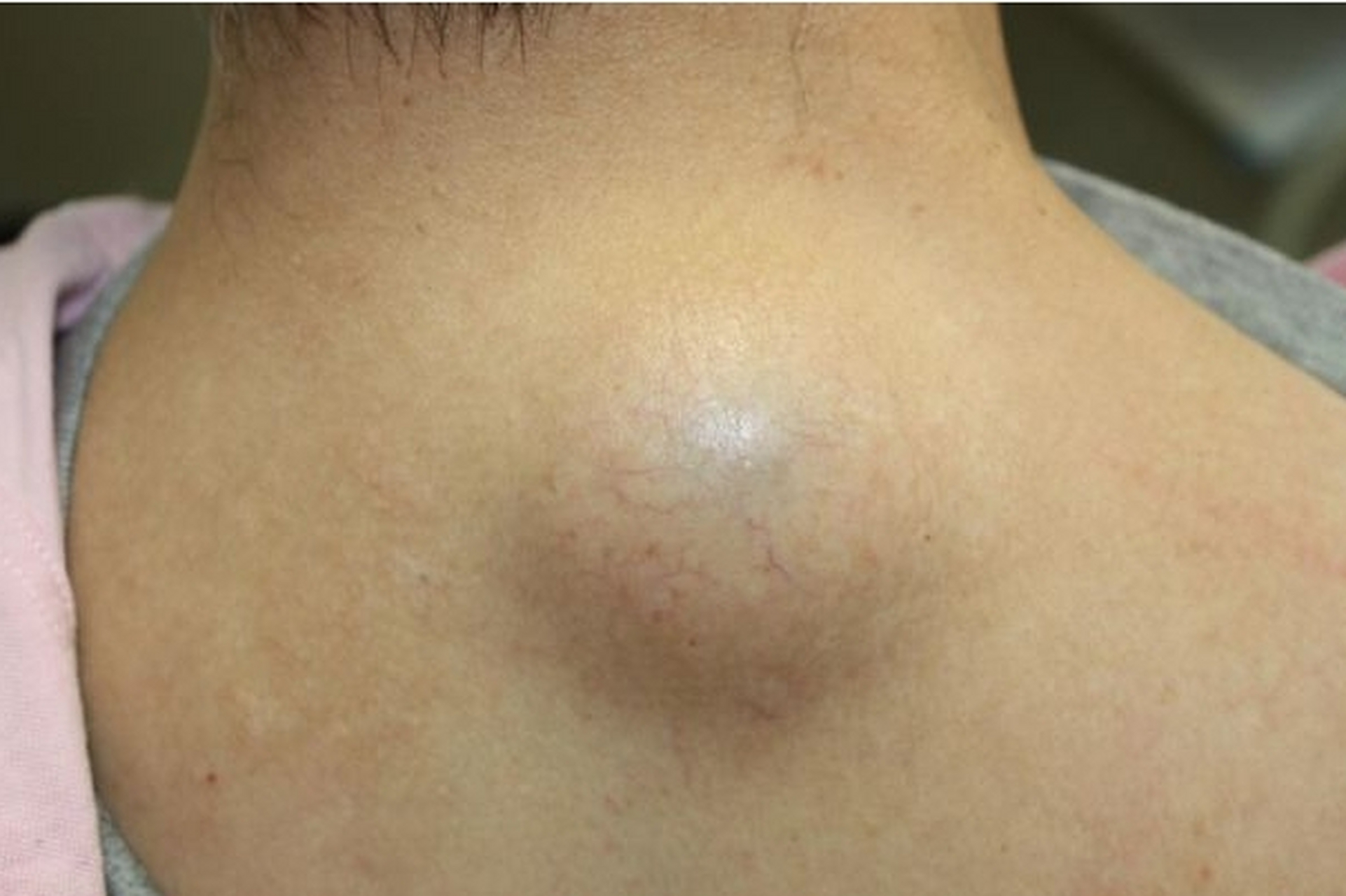 1,颈部的包块,多见于颈前,喉结位置附近,如果这个地方出现质地较硬