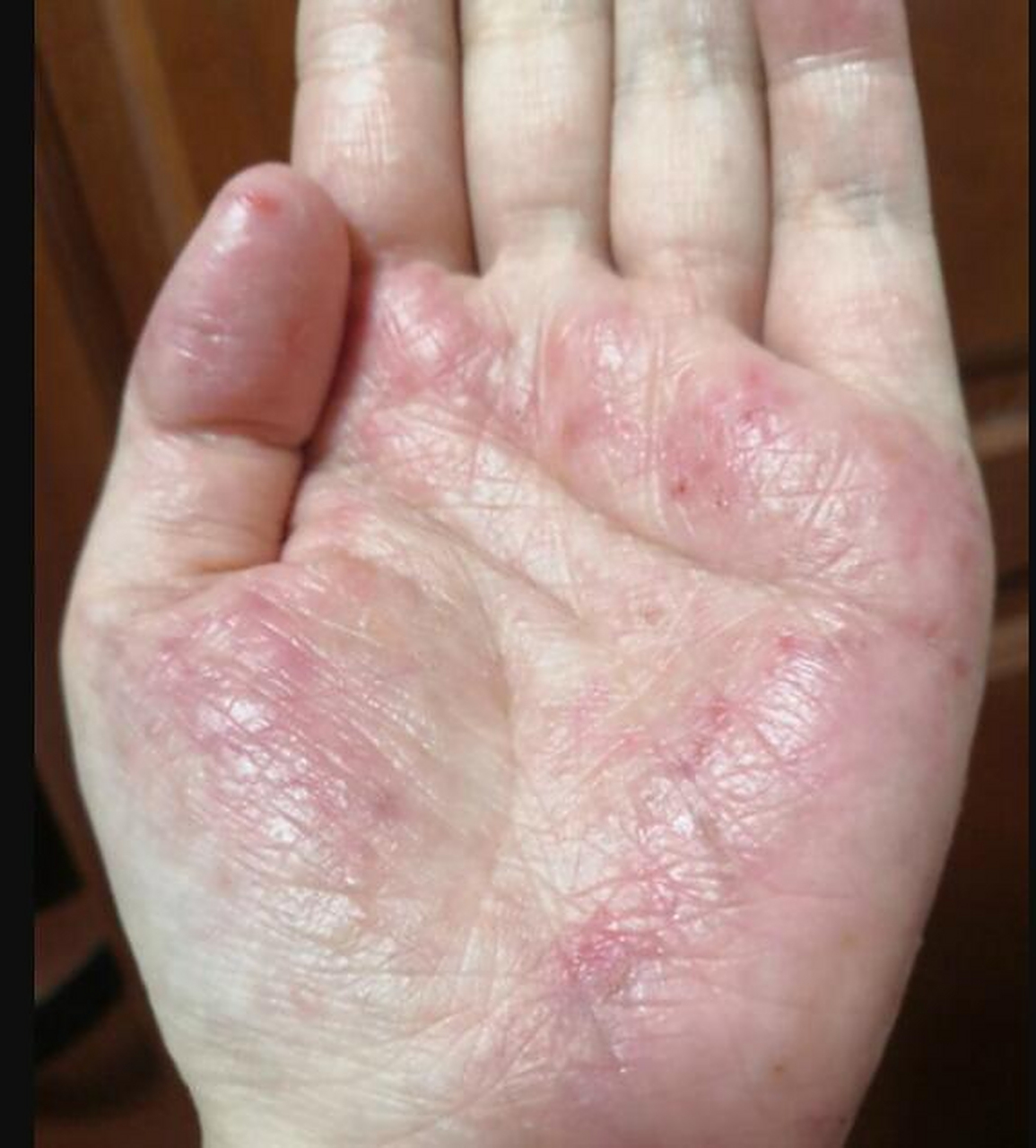 腘窝  4.手掌  5.