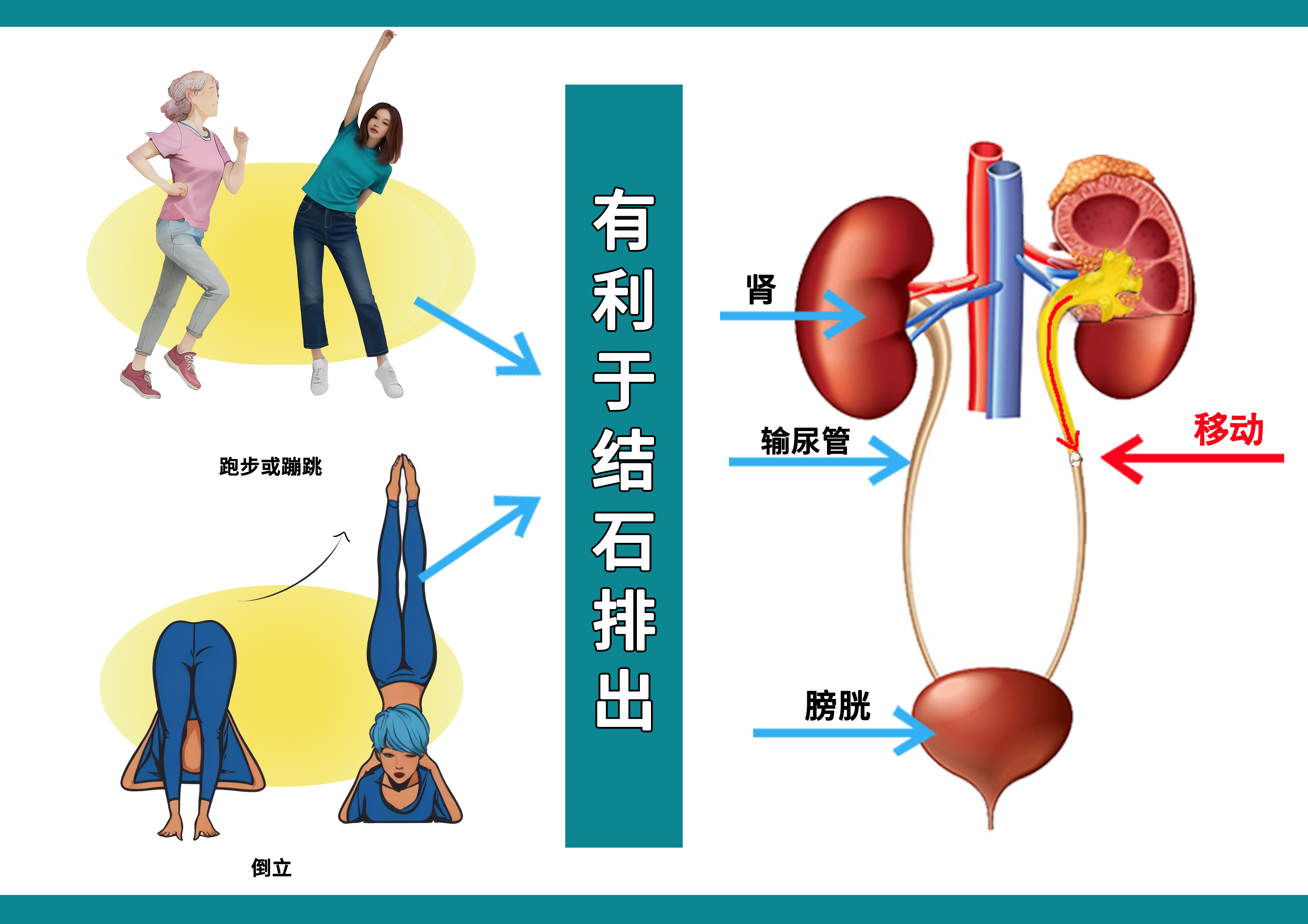 肾结石排石路线图图片