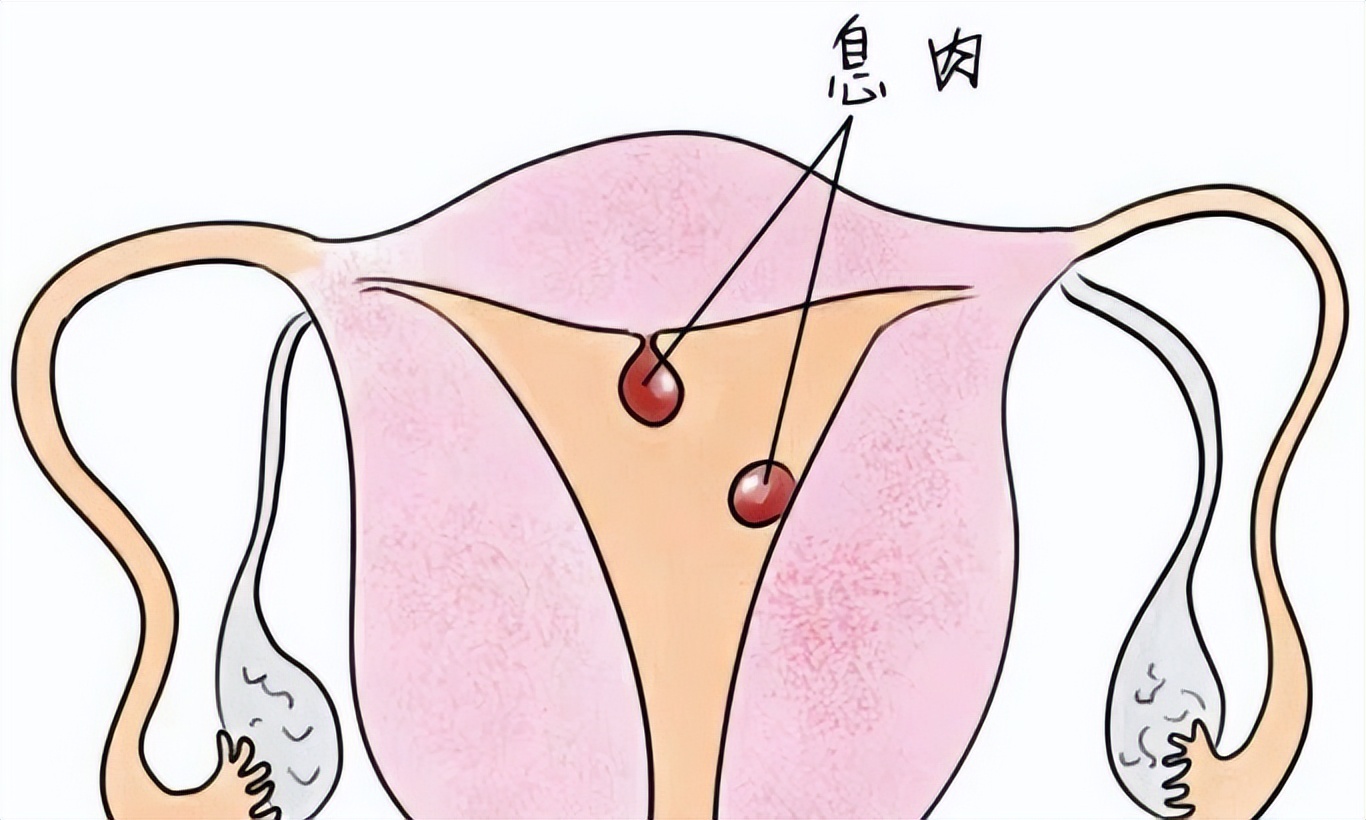 子宫内膜息肉标本图片