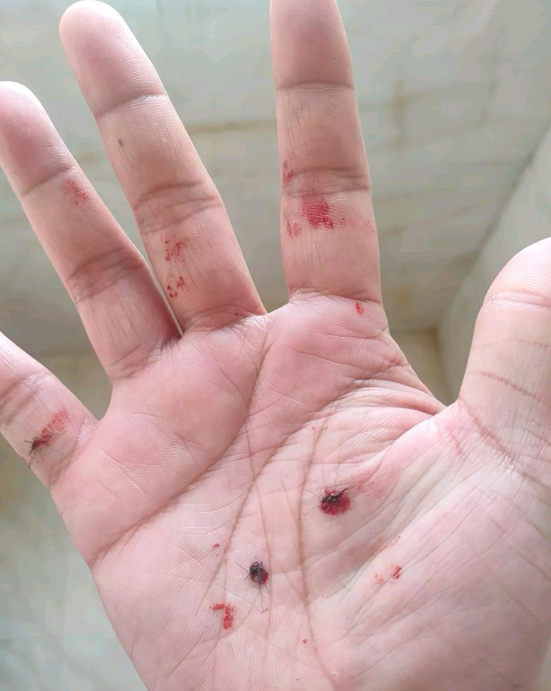睡一觉起来浑身都是包,这玩意就是打不干净,坐着躺