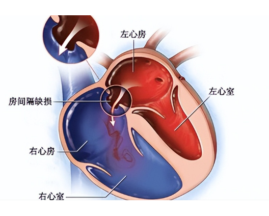 二尖瓣位于图片