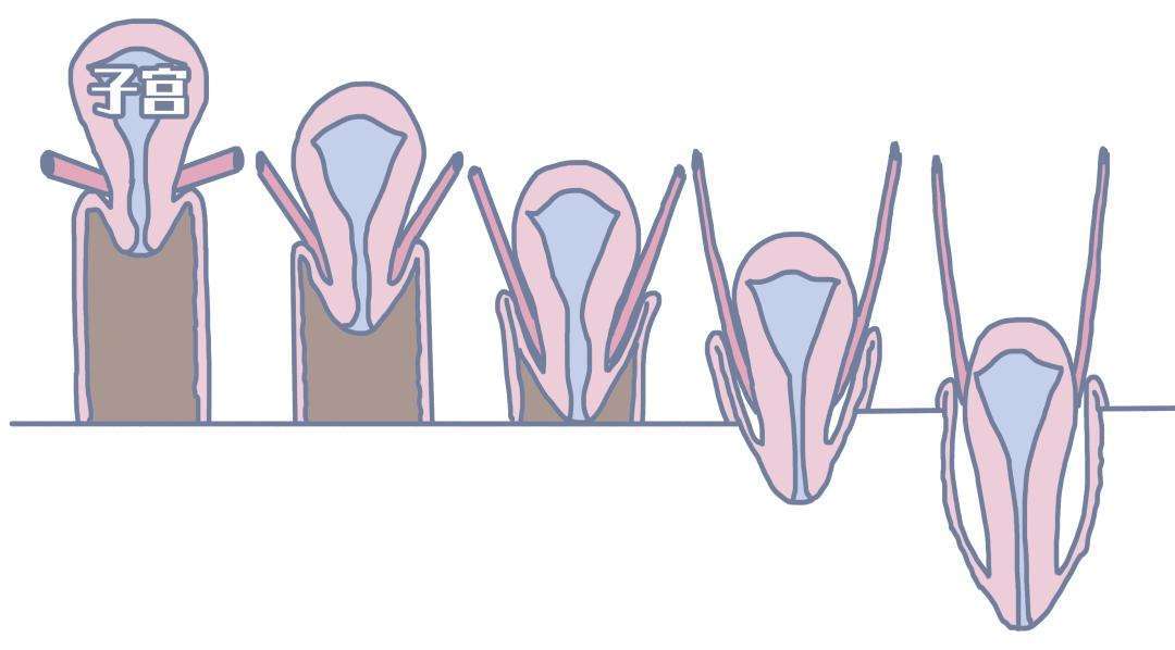膀胱下垂,伴随咳嗽漏尿,该选什么手术?