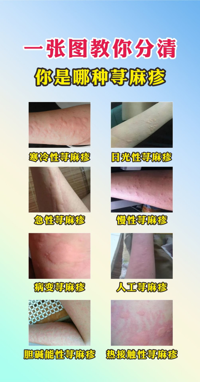 荨麻疹# #慢性荨麻疹