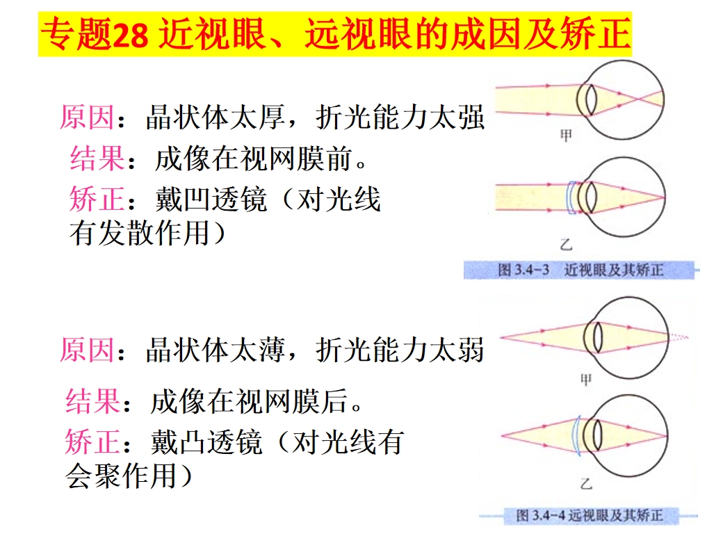 近视眼怎么恢复