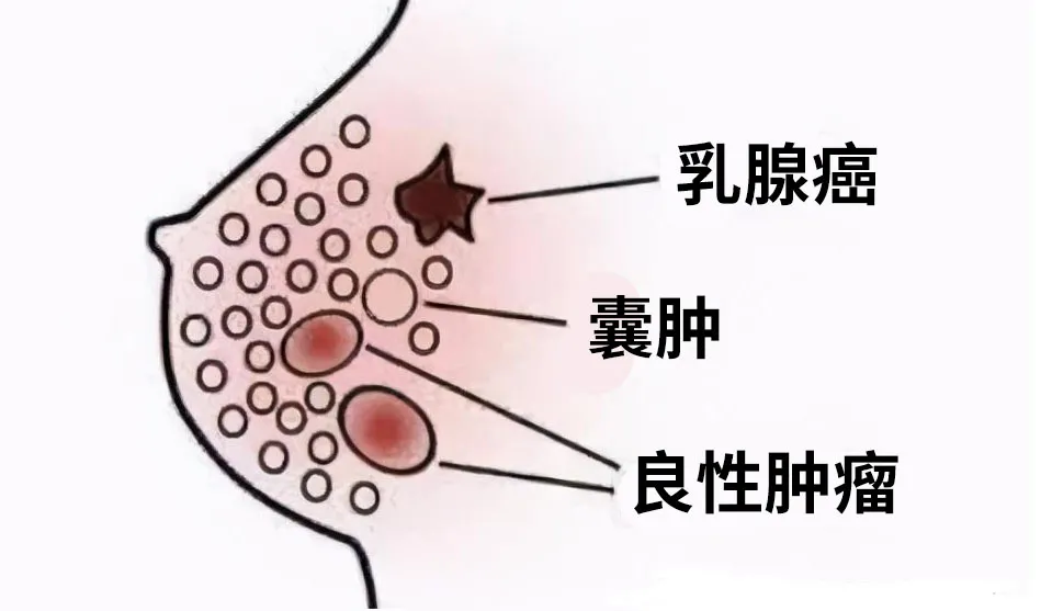 乳腺结节,其实是痰糊住了血液  现代医学认为结节是增生物,所以小的