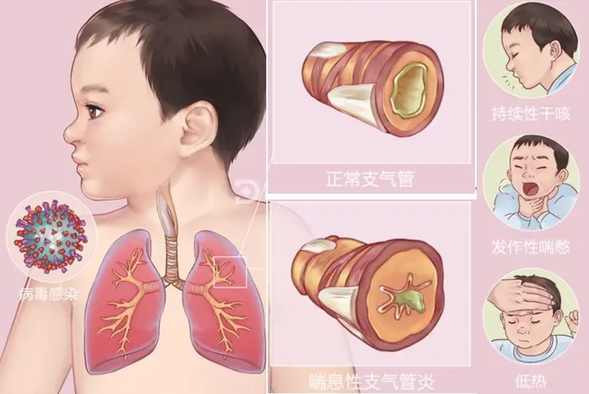 咳嗽:这是喘息性支气管炎最常见的症状,通常是阵发性,连续性和剧烈性