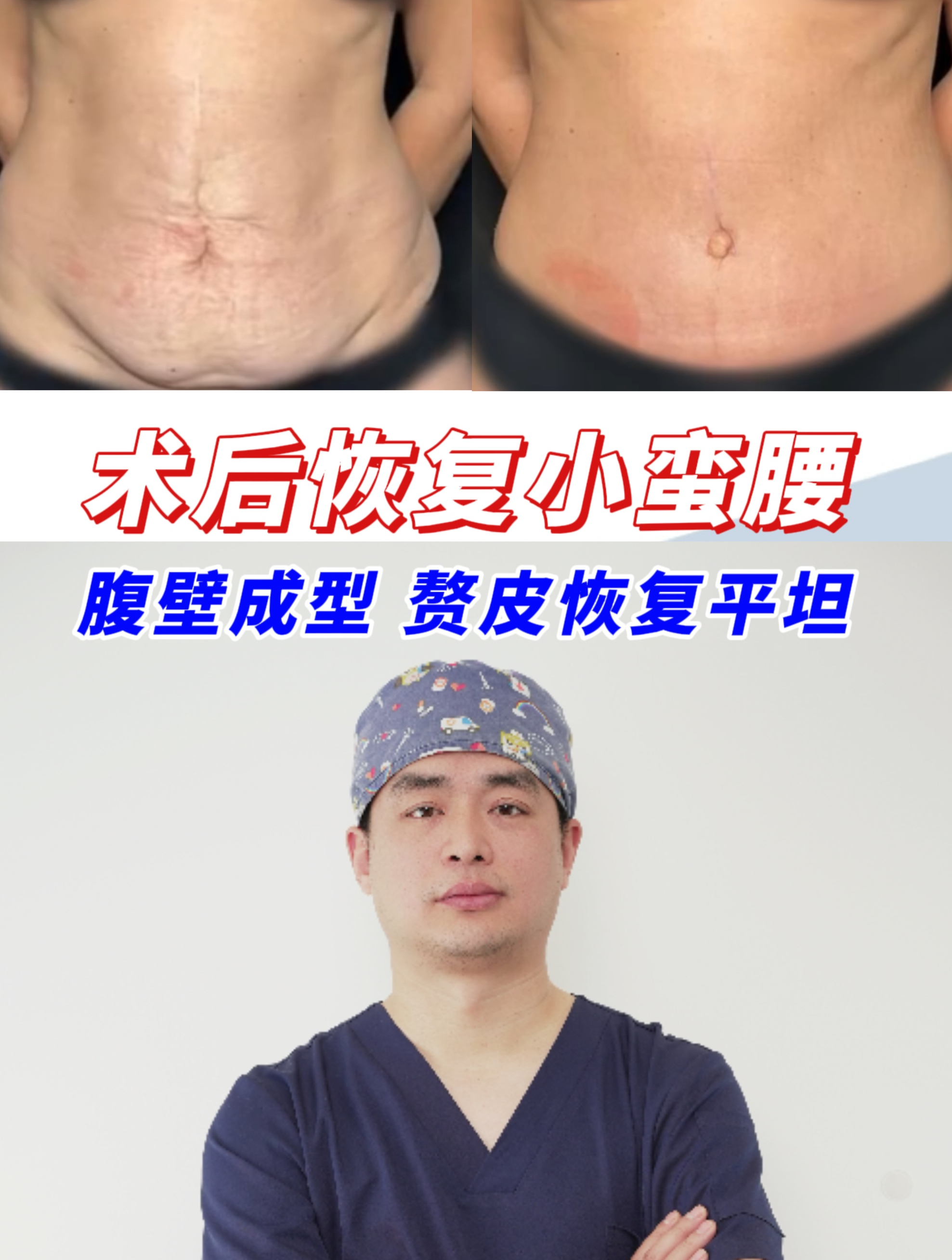 腹壁成形术后 宝妈松垂垮皱的肚腩恢复平坦 找回了小蛮腰!