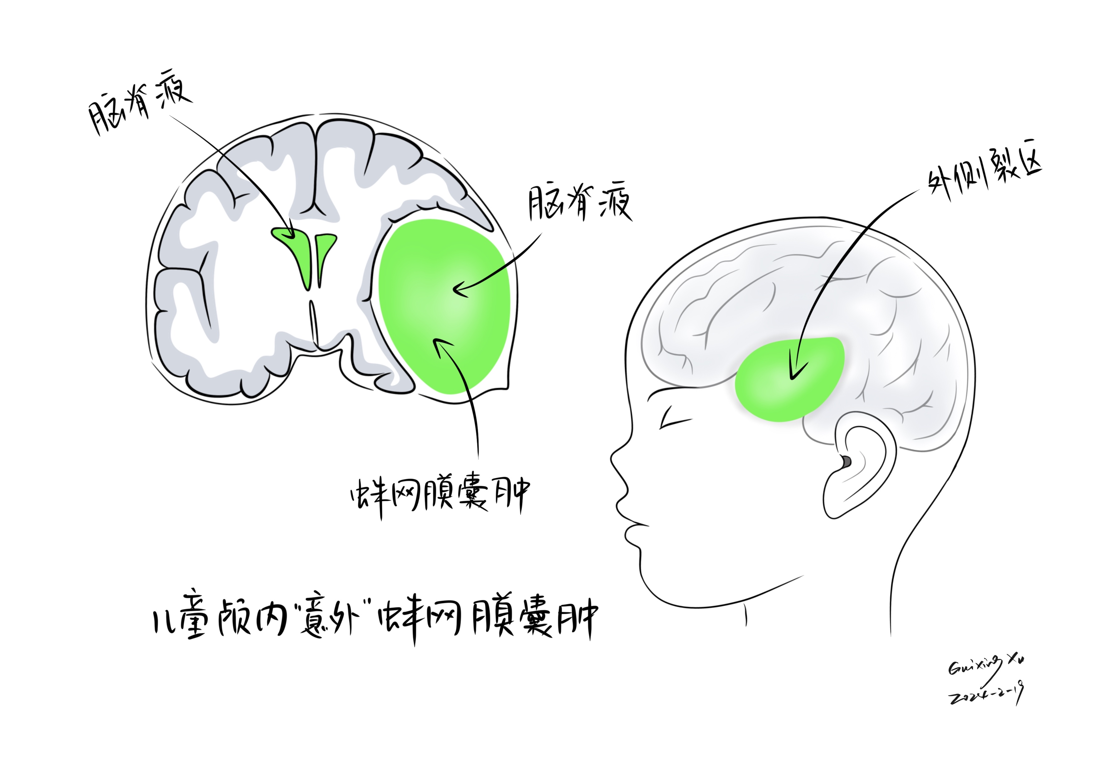 枕部蛛网膜囊肿图片