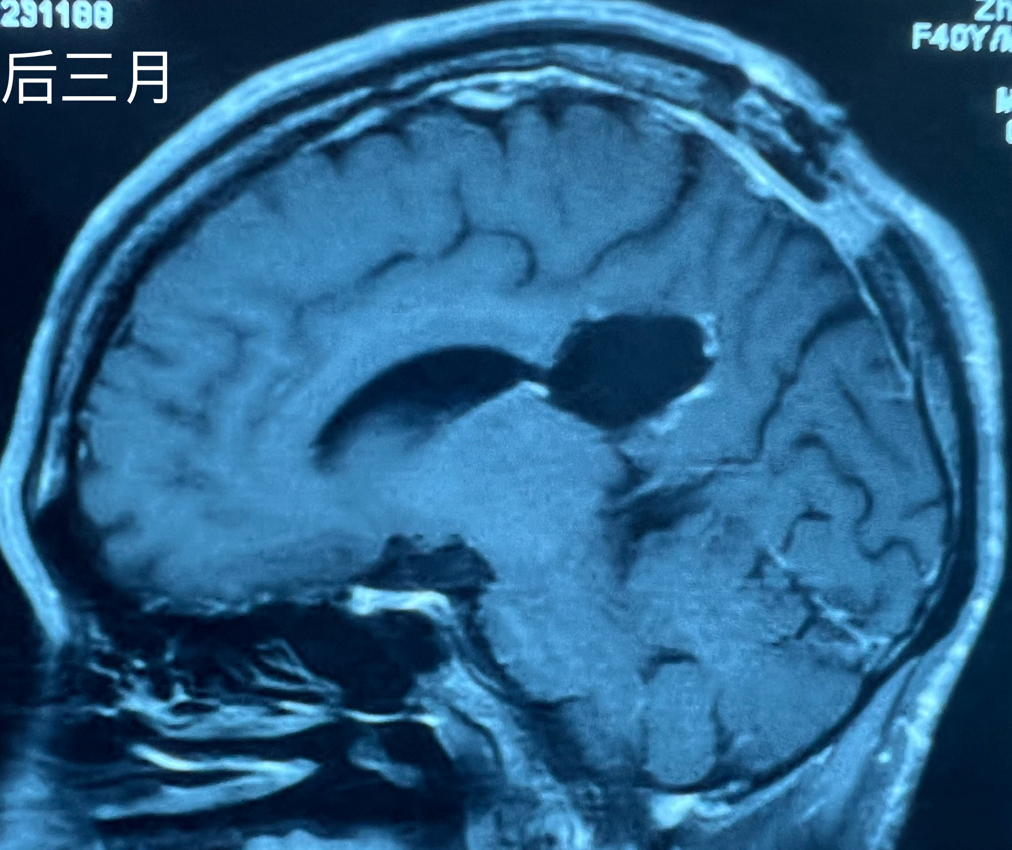 胼胝体胶质瘤图片