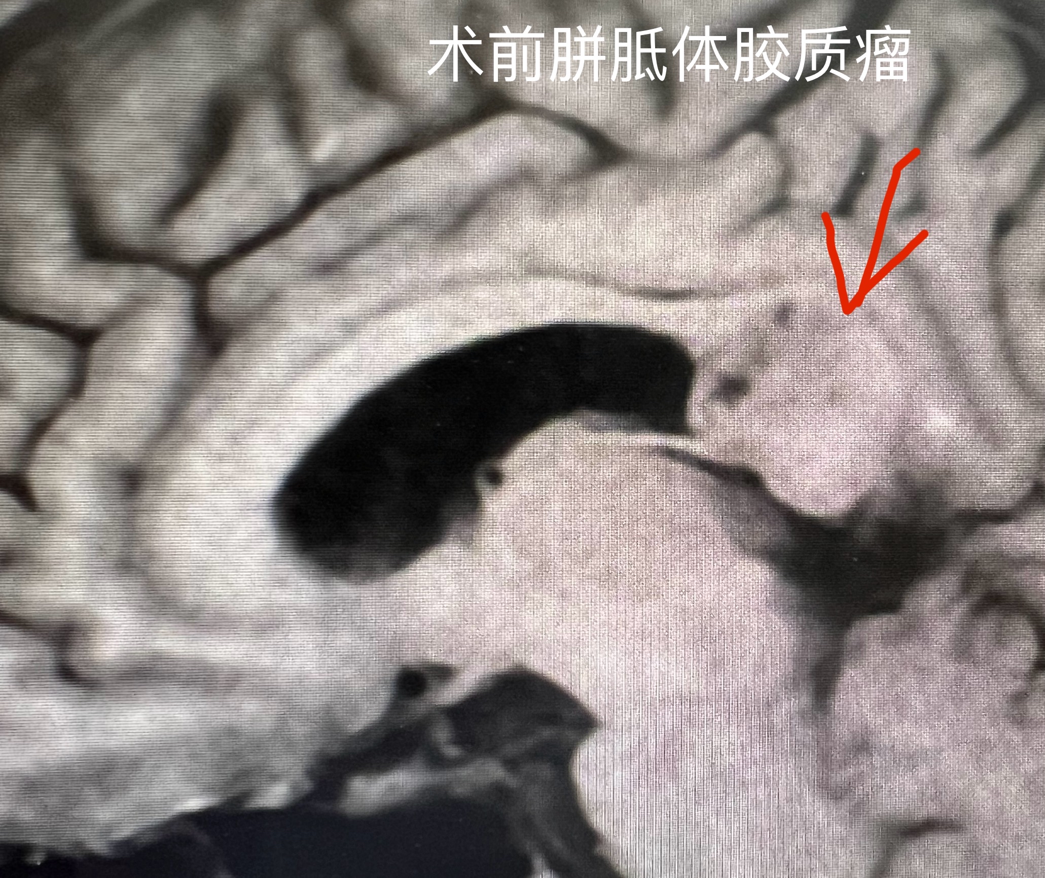 胼胝体胶质瘤图片