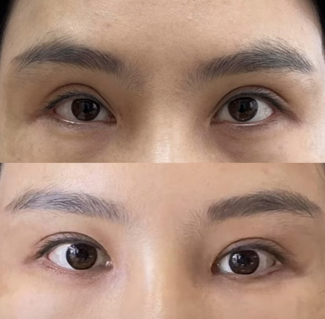 该求美者术前双眼皮肉条感明显,眼双眼皮线条不流畅,黏连,臃肿,眼睛