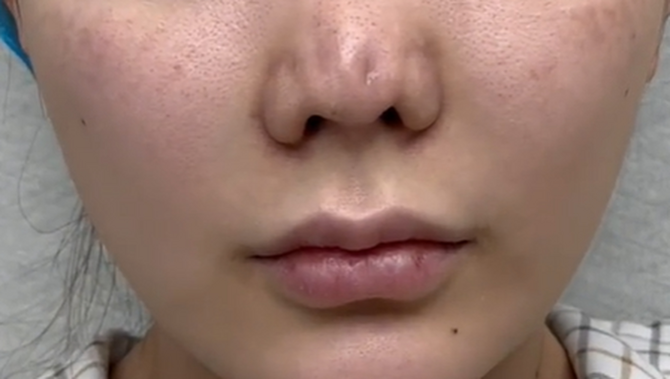 鼻假体取出,鼻子会发生挛缩吗?