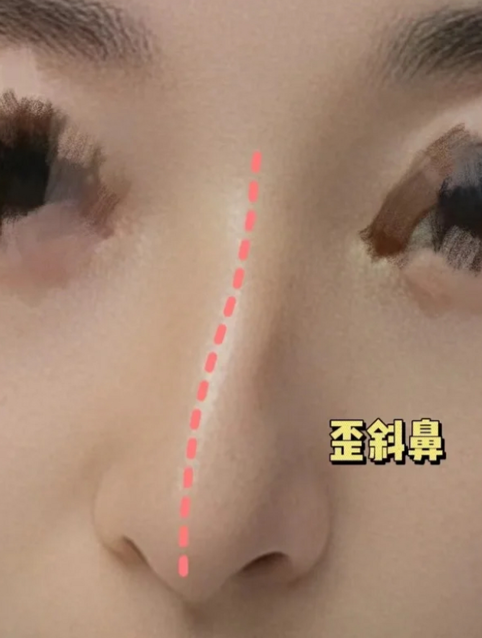歪斜鼻是如何形成的7515  --歪斜鼻形成原因 歪鼻即鼻部歪斜,包括