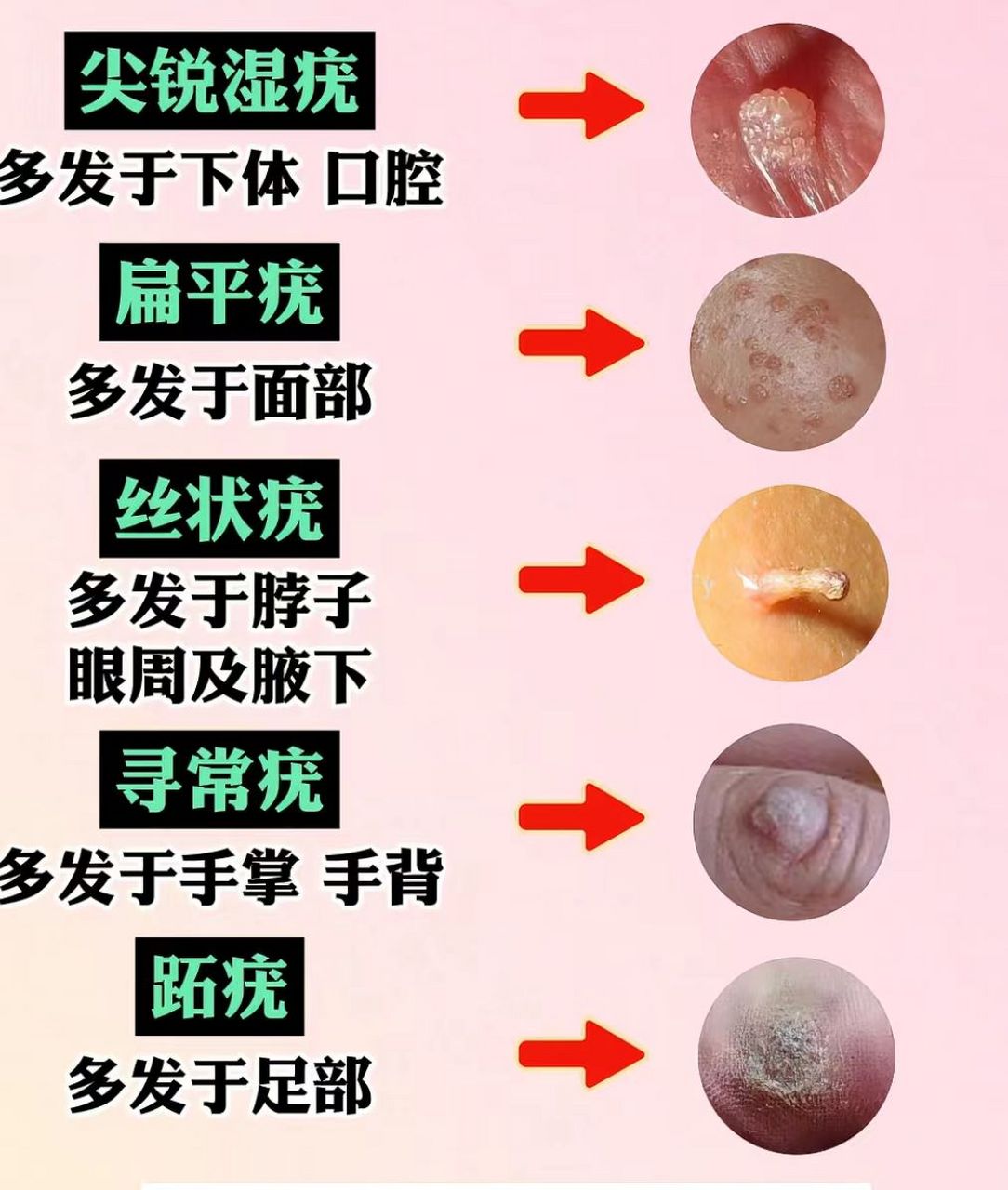 感染hpv后身体长出的5种疣分别是啥样子?一图带你了解
