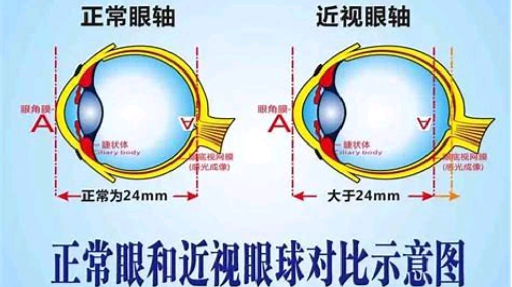 近视时,眼轴会变长,使得眼球的前后径增加,进而导致眼睛看起来有些