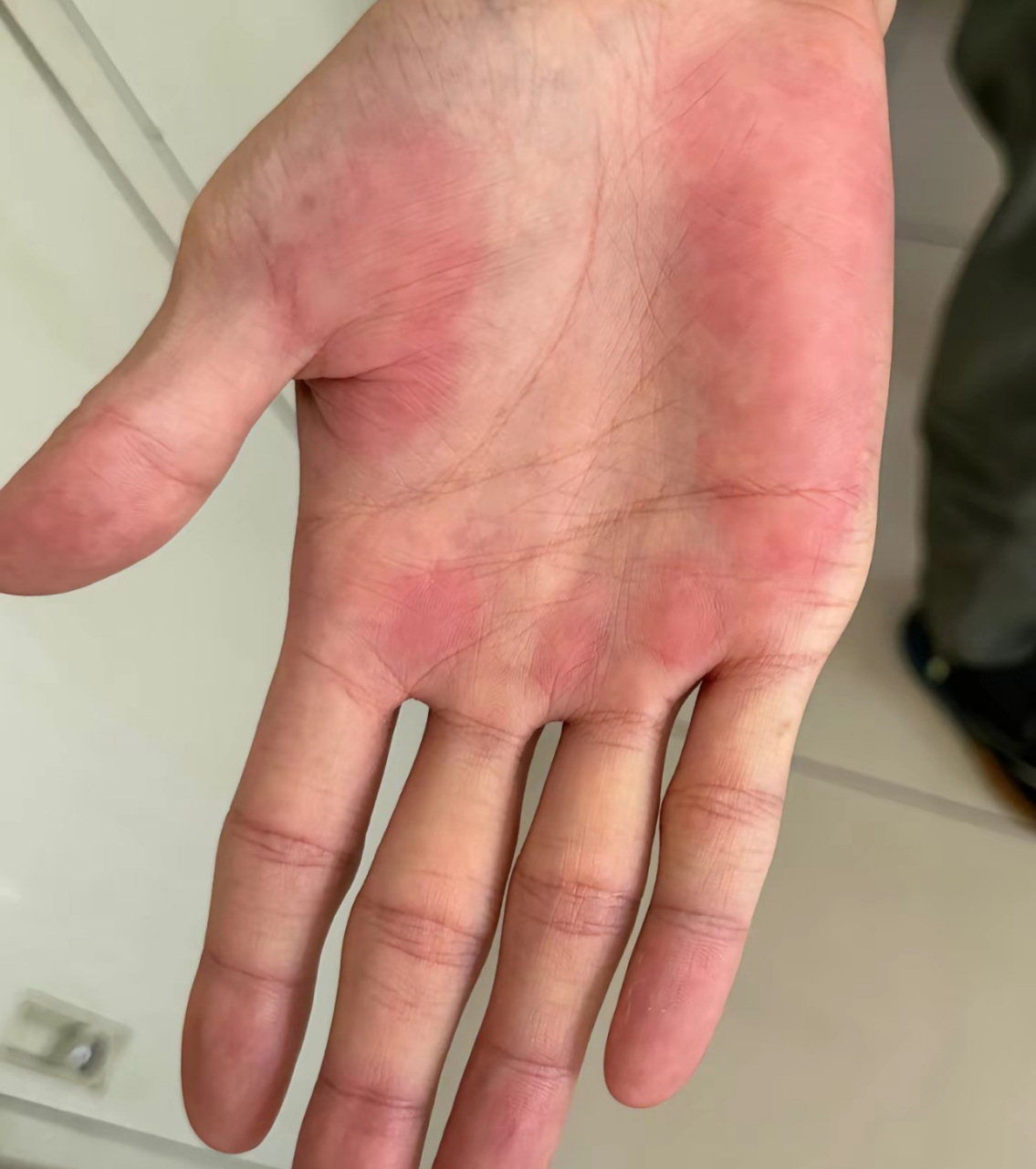 仅仅一个月,肝癌到过世,肝掌就是前兆!