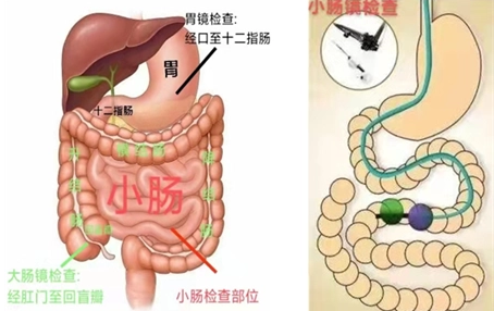 肠镜6张图片对应部位图片