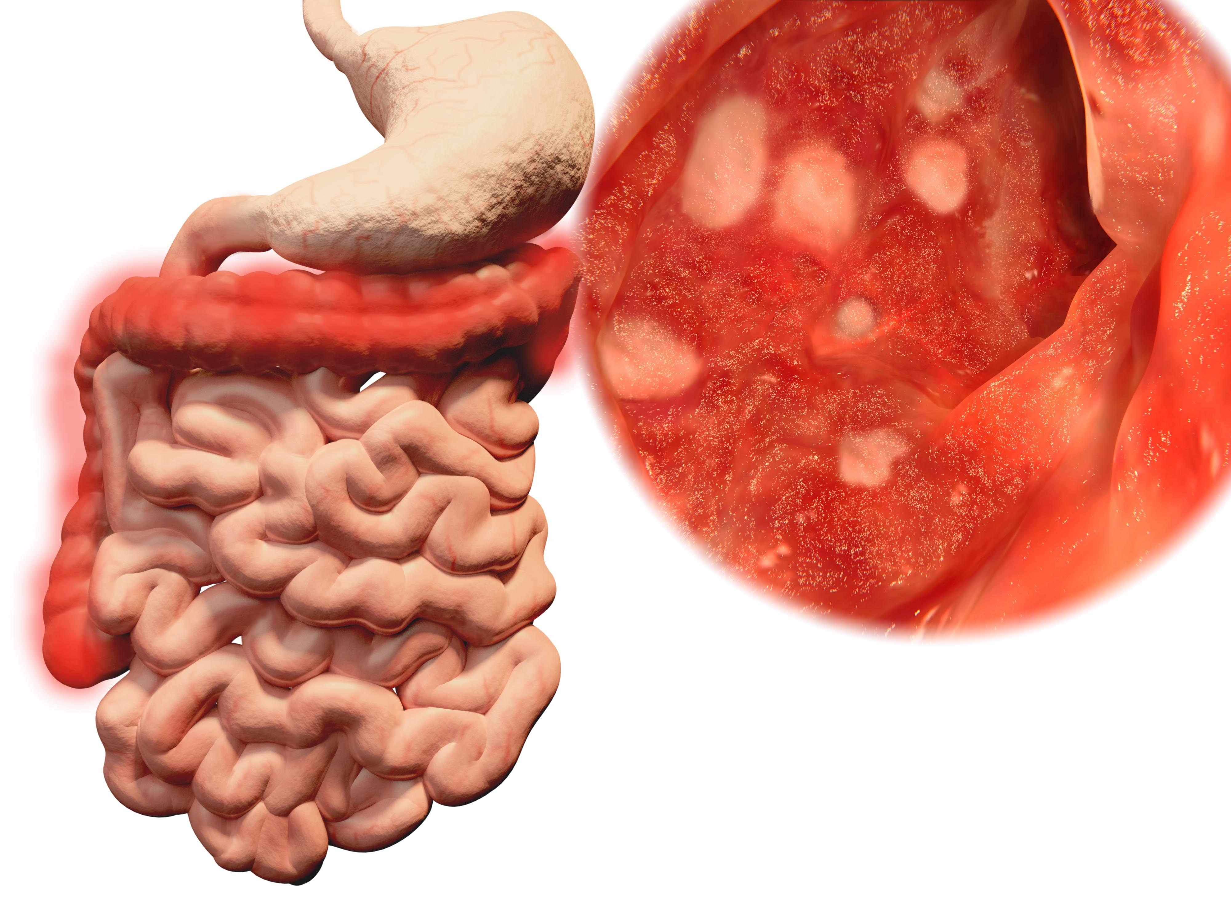 体检发现有结肠息肉,要治疗?医生:这2种易癌变,需要尽早治疗