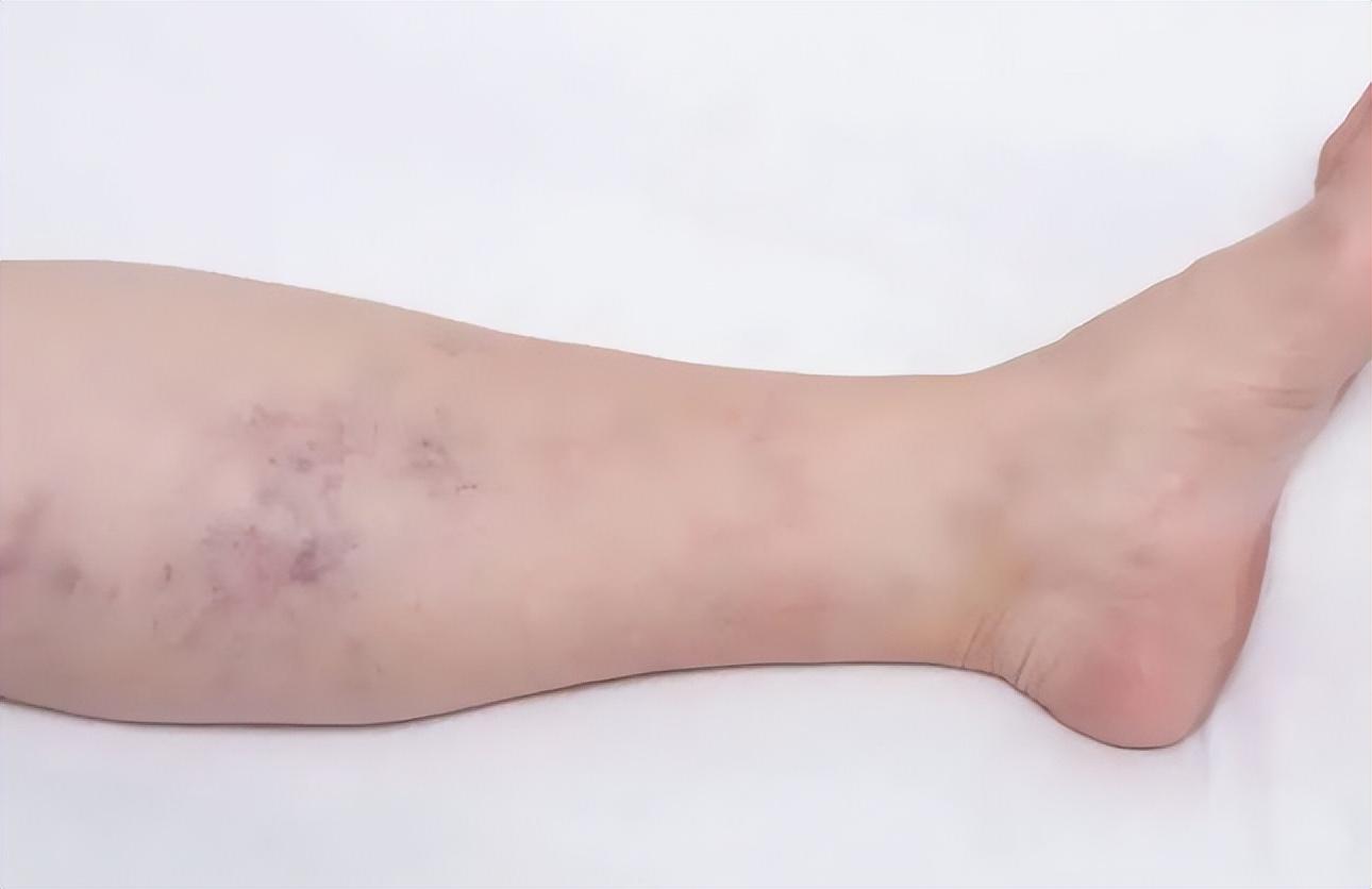 发现腿上出现淤青 12岁被确诊为骨癌