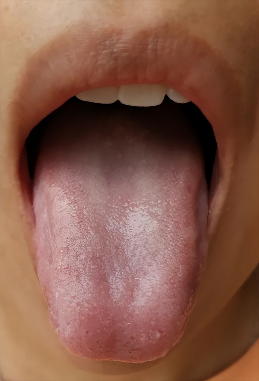 这种长条舌,当心肝血不足!这个方子,能把亏掉的肝血补回来!