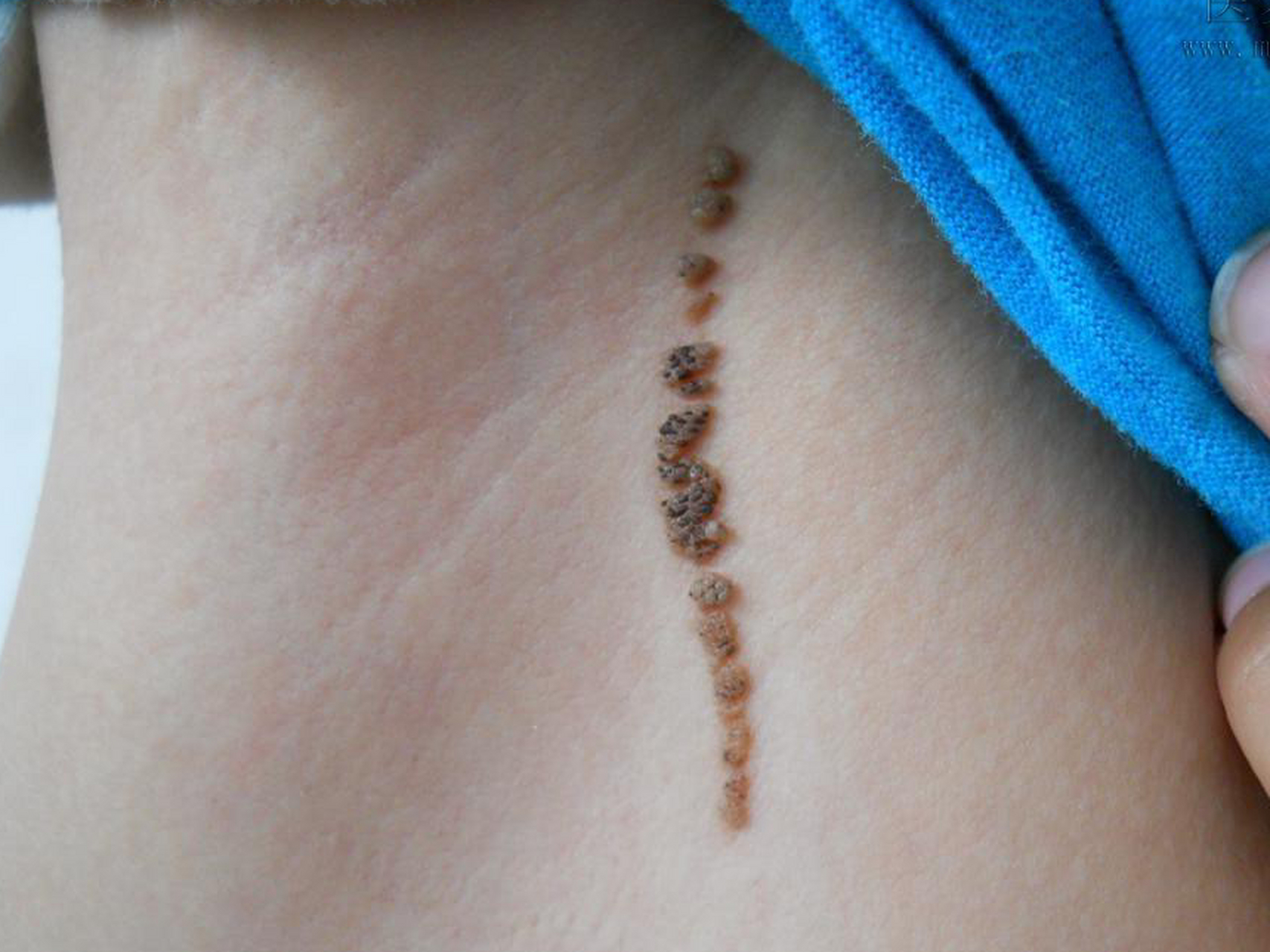 疣状痣(图一)是单纯的表皮增生,外观上像很多疣聚集在一起,颜色大概