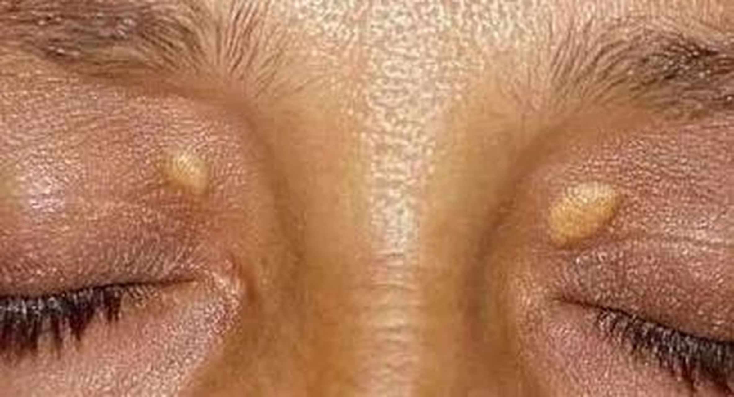 有没有留意到妈妈的眼睑周围有这种黄色的斑块儿,如