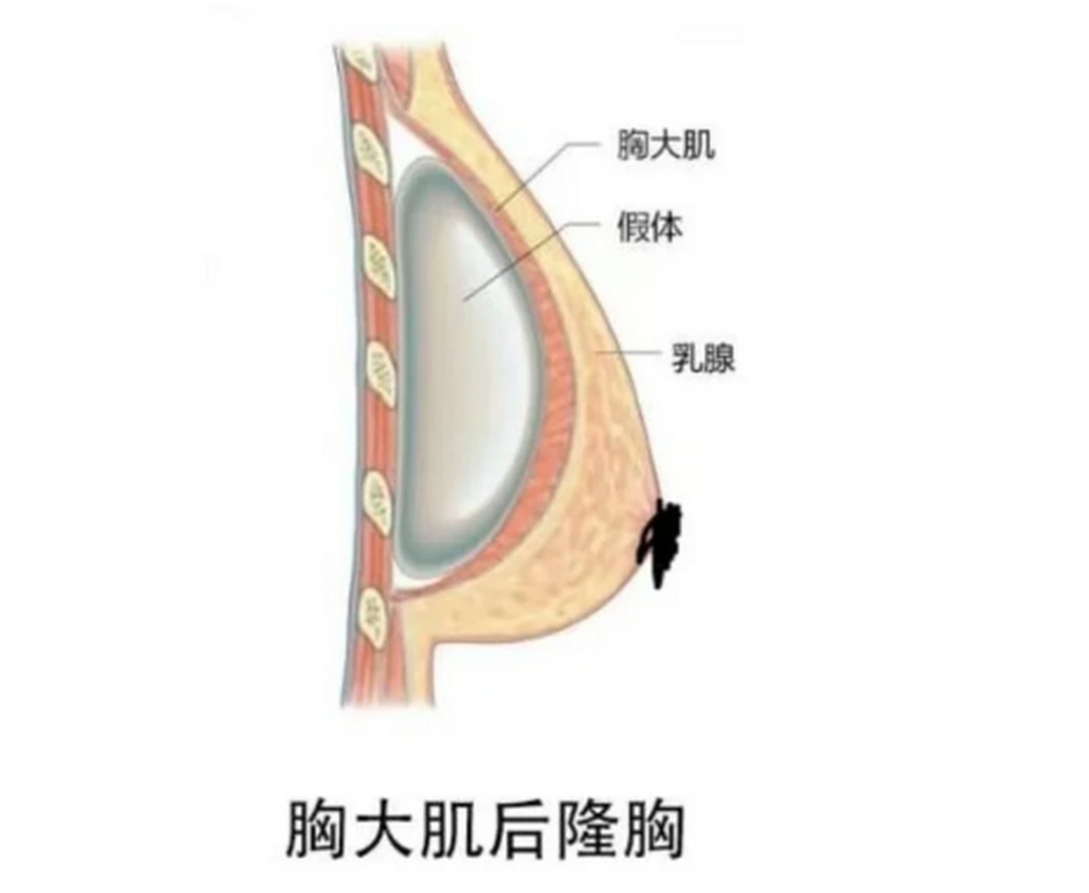 假体隆胸180是多大图片图片