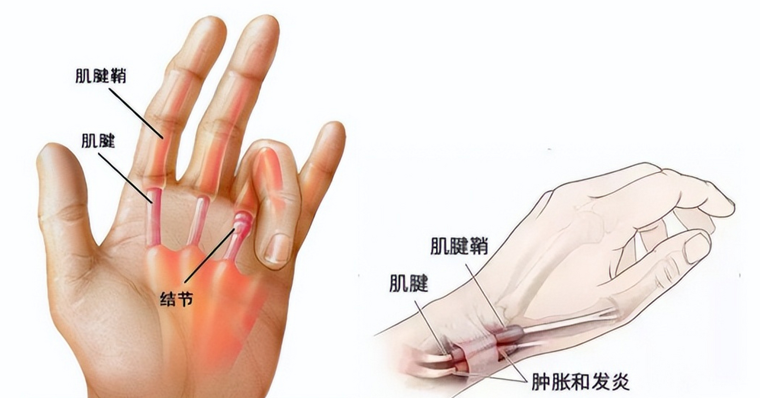 腱鞘炎照片图片