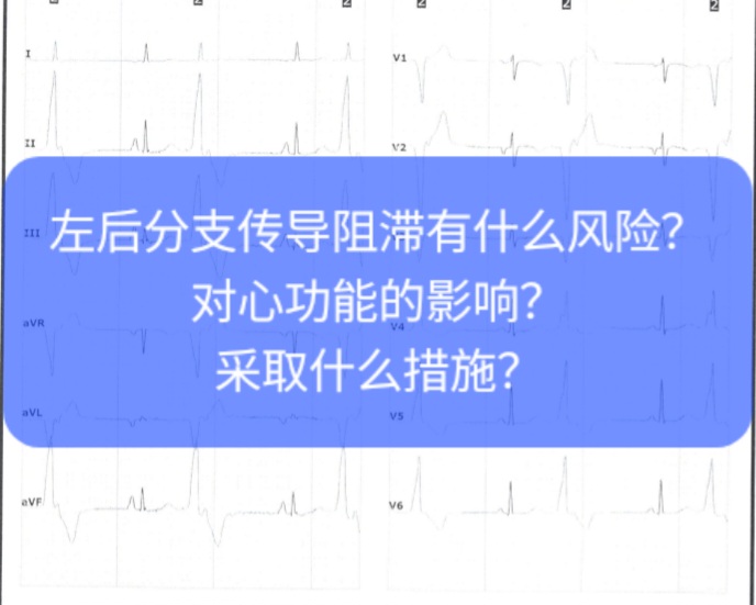 左后分支传导阻滞图片